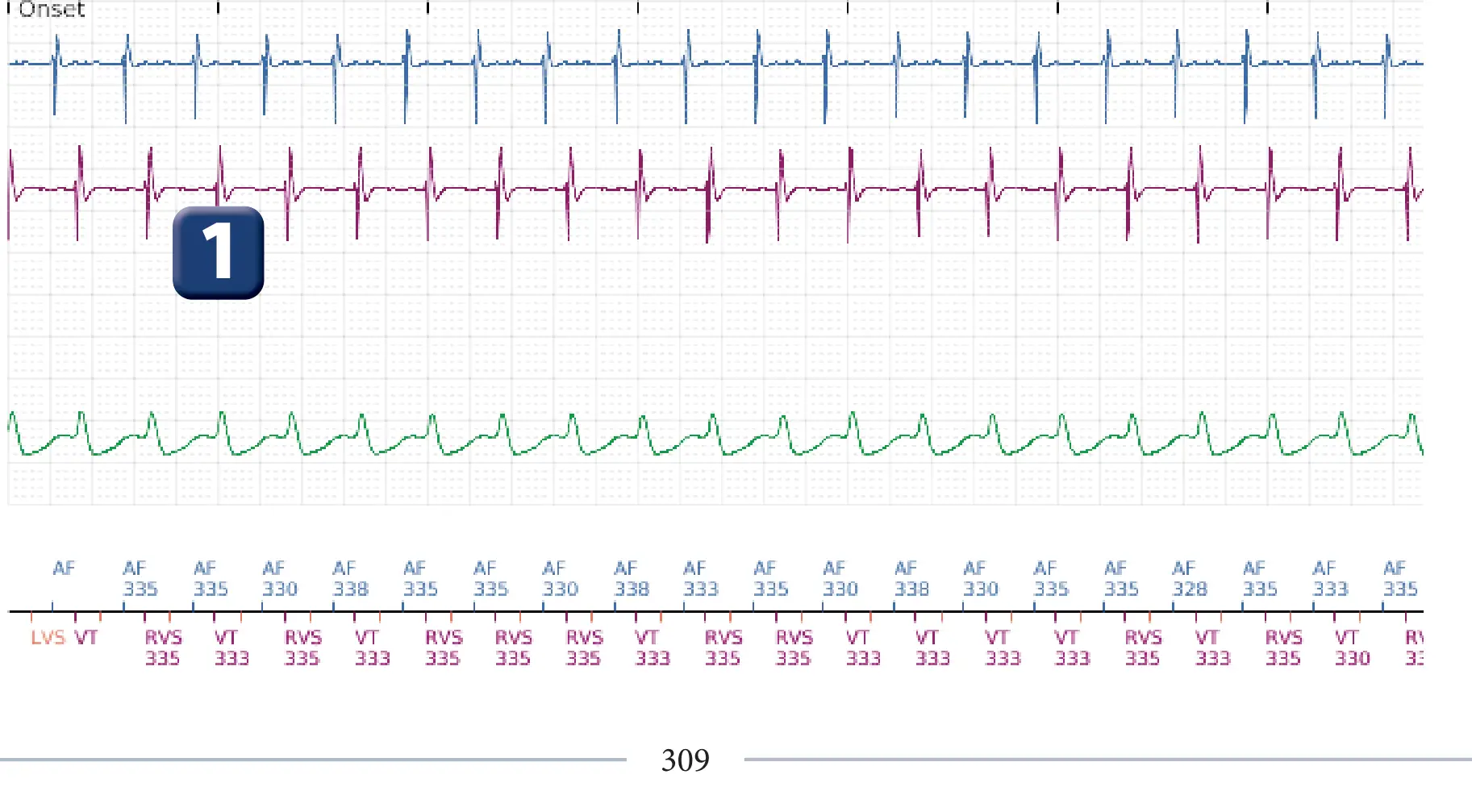 Boston Scientific ICD electrogram, segment 1 of 3 — Dual chamber discrimination, atrial tachycardia