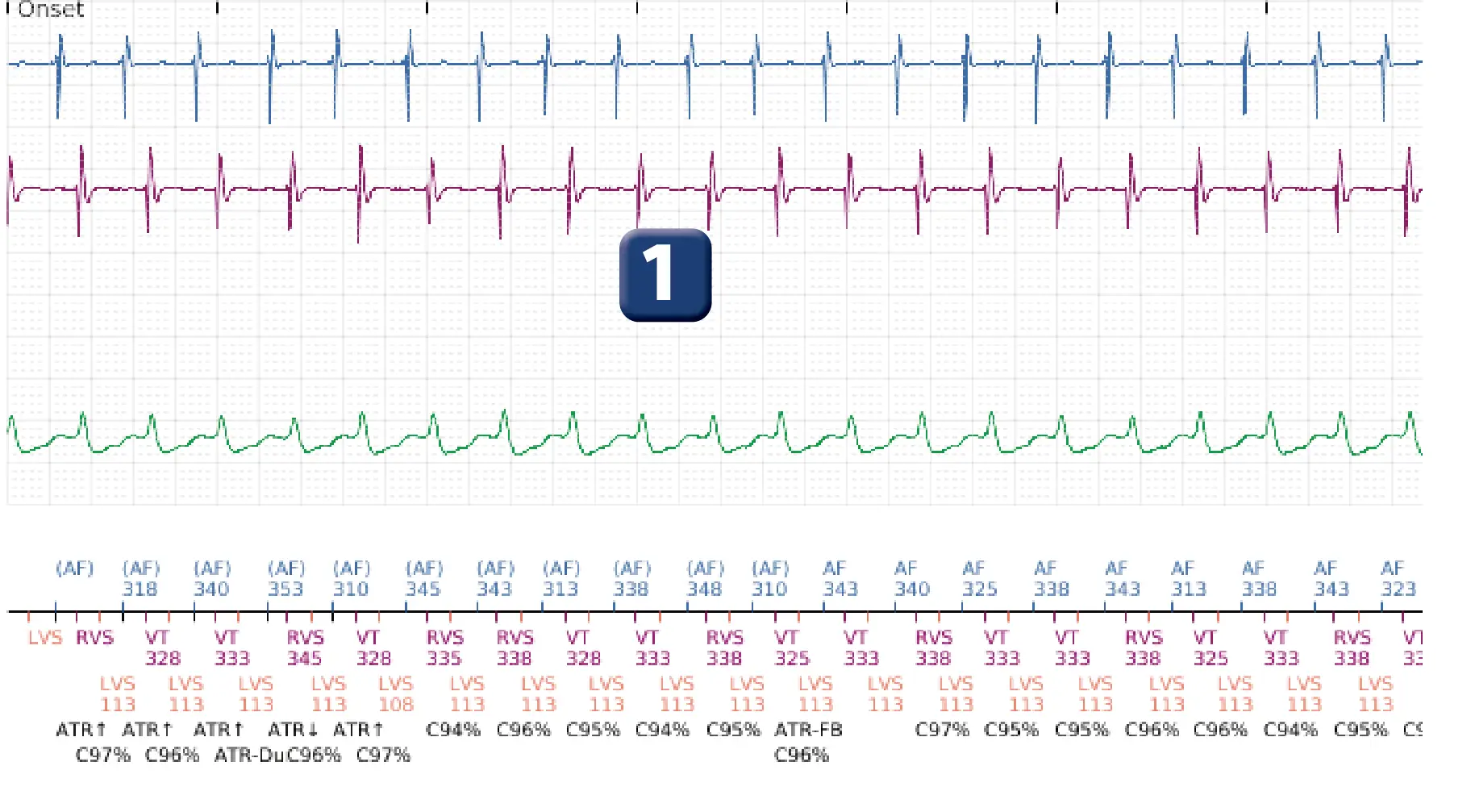 Boston Scientific ICD electrogram, segment 1 of 4 — Dual chamber discrimination, atrial tachycardia