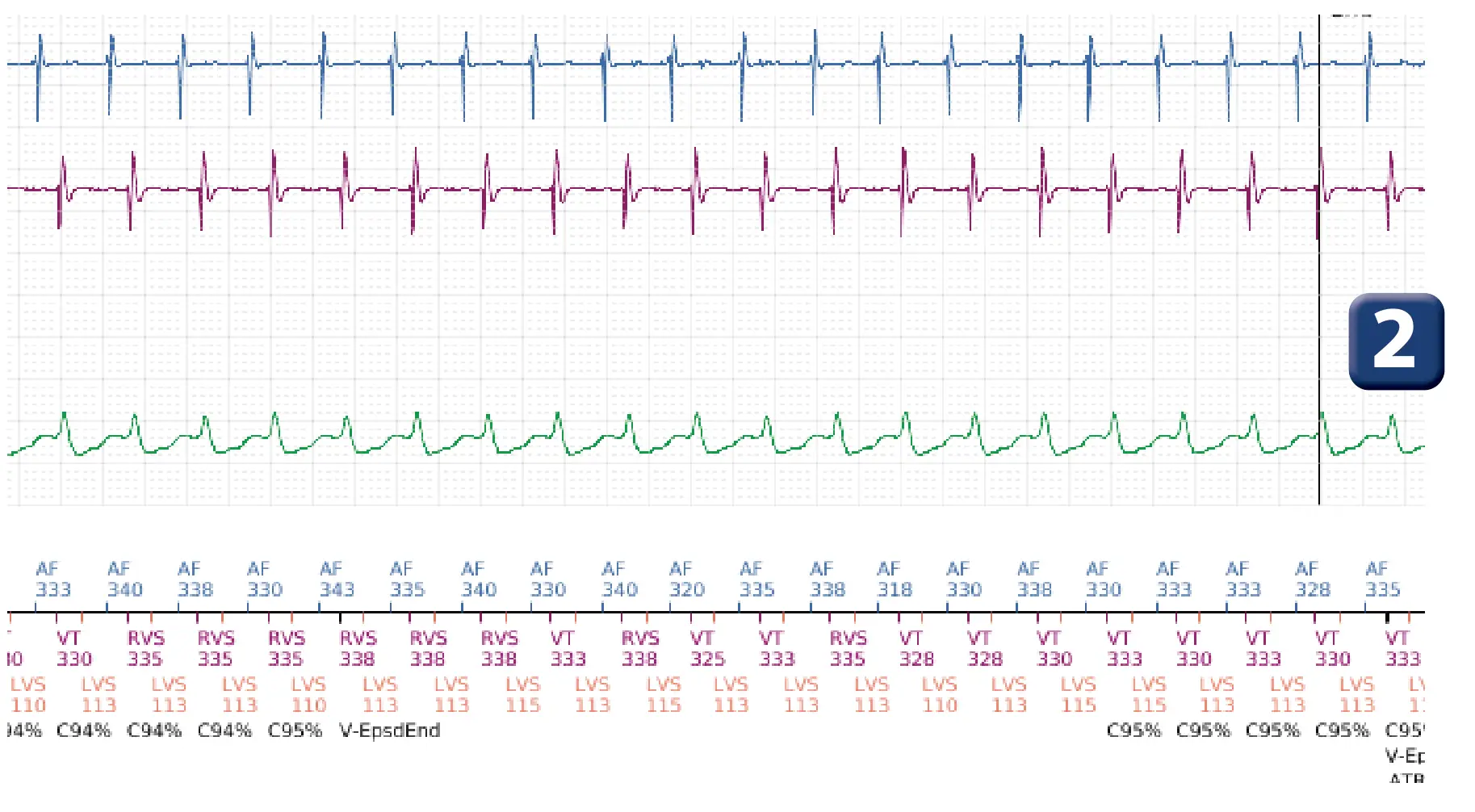 Boston Scientific ICD electrogram, segment 2 of 4 — Dual chamber discrimination, atrial tachycardia