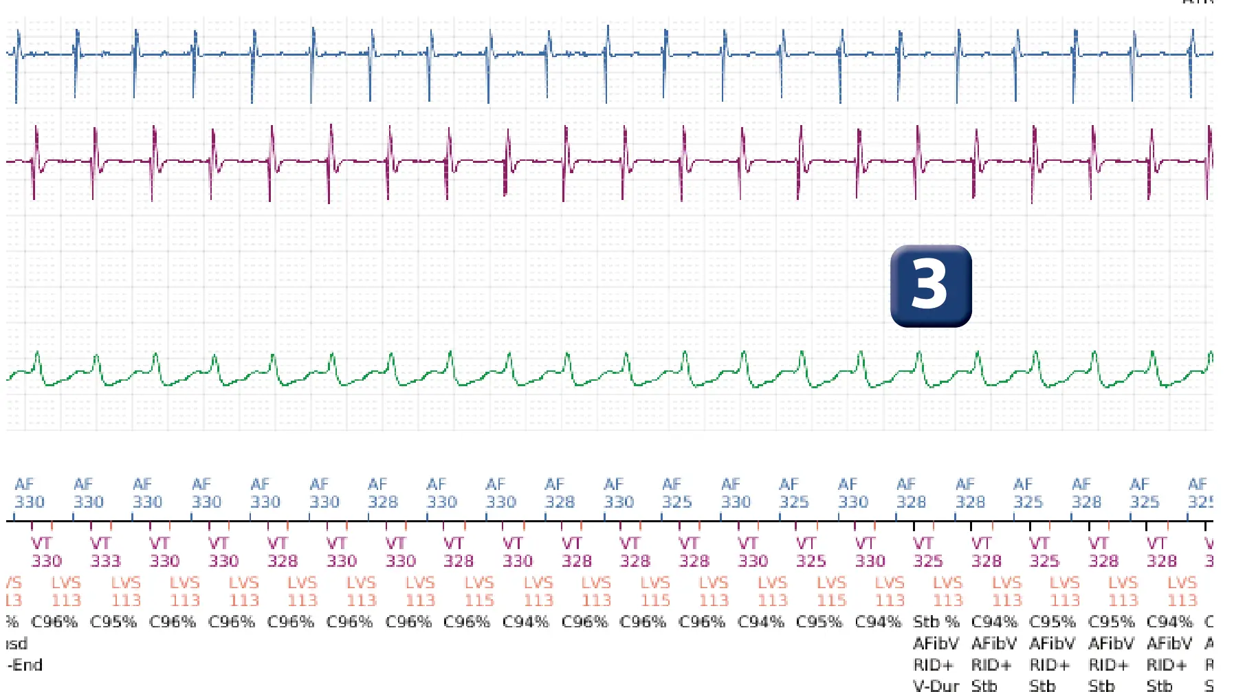Boston Scientific ICD electrogram, segment 3 of 4 — Dual chamber discrimination, atrial tachycardia