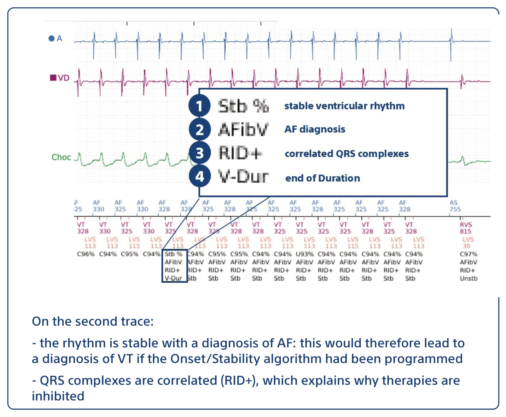 On the second trace: - the rhythm is stable with a diagnosis of AF: this would therefore lead to a diagnosis of VT if the Onset/Stability algorithm had been programmed - QRS complexes are correlated (RID+), which explains why therapies are inhibited