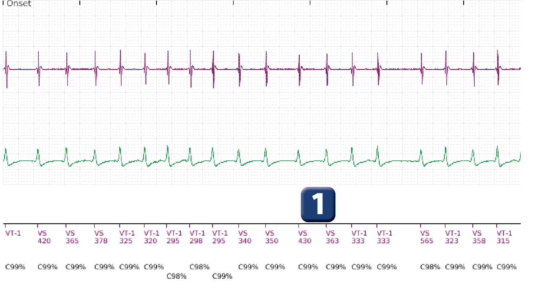 Boston Scientific ICD electrogram, segment 1 of 5 — Single-chamber discrimination, Rhythm ID and an atrial fibrillation episode