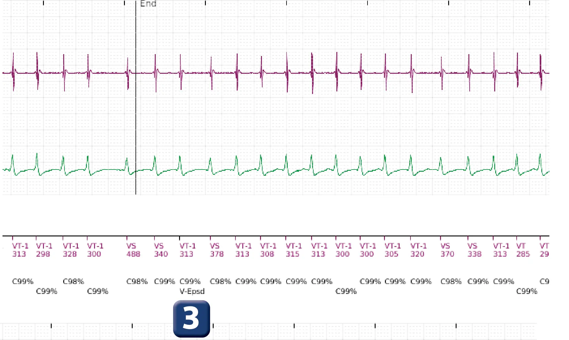 Boston Scientific ICD electrogram, segment 3 of 5 — Single-chamber discrimination, Rhythm ID and an atrial fibrillation episode