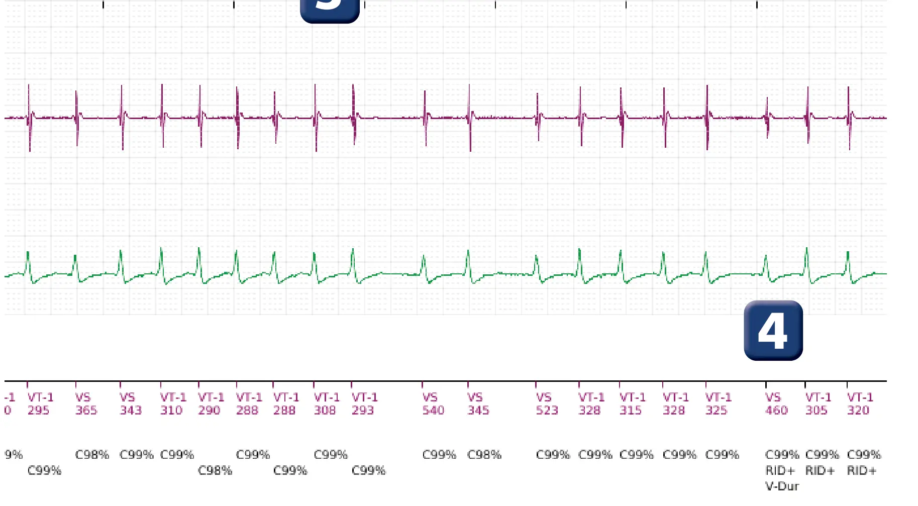 Boston Scientific ICD electrogram, segment 4 of 5 — Single-chamber discrimination, Rhythm ID and an atrial fibrillation episode
