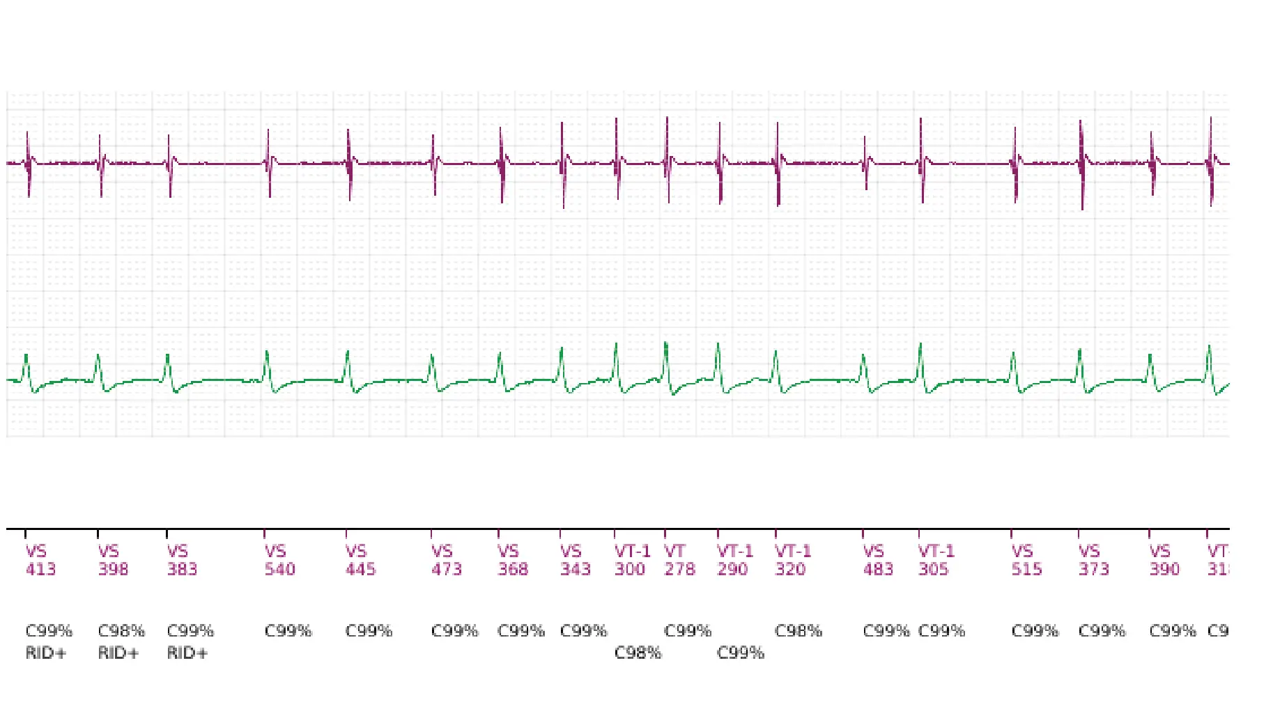 Boston Scientific ICD electrogram, segment 5 of 5 — Single-chamber discrimination, Rhythm ID and an atrial fibrillation episode