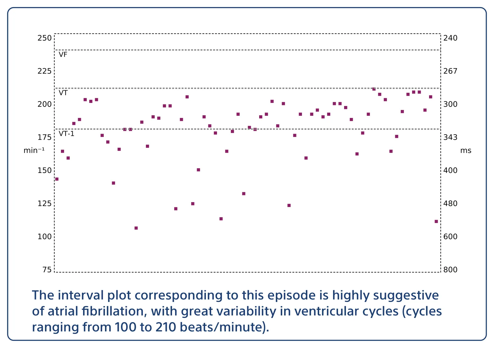 The interval plot corresponding to this episode is highly suggestive of atrial fibrillation, with great variability in ventricular cycles (cycles ranging from 100 to 210 beats/minute).