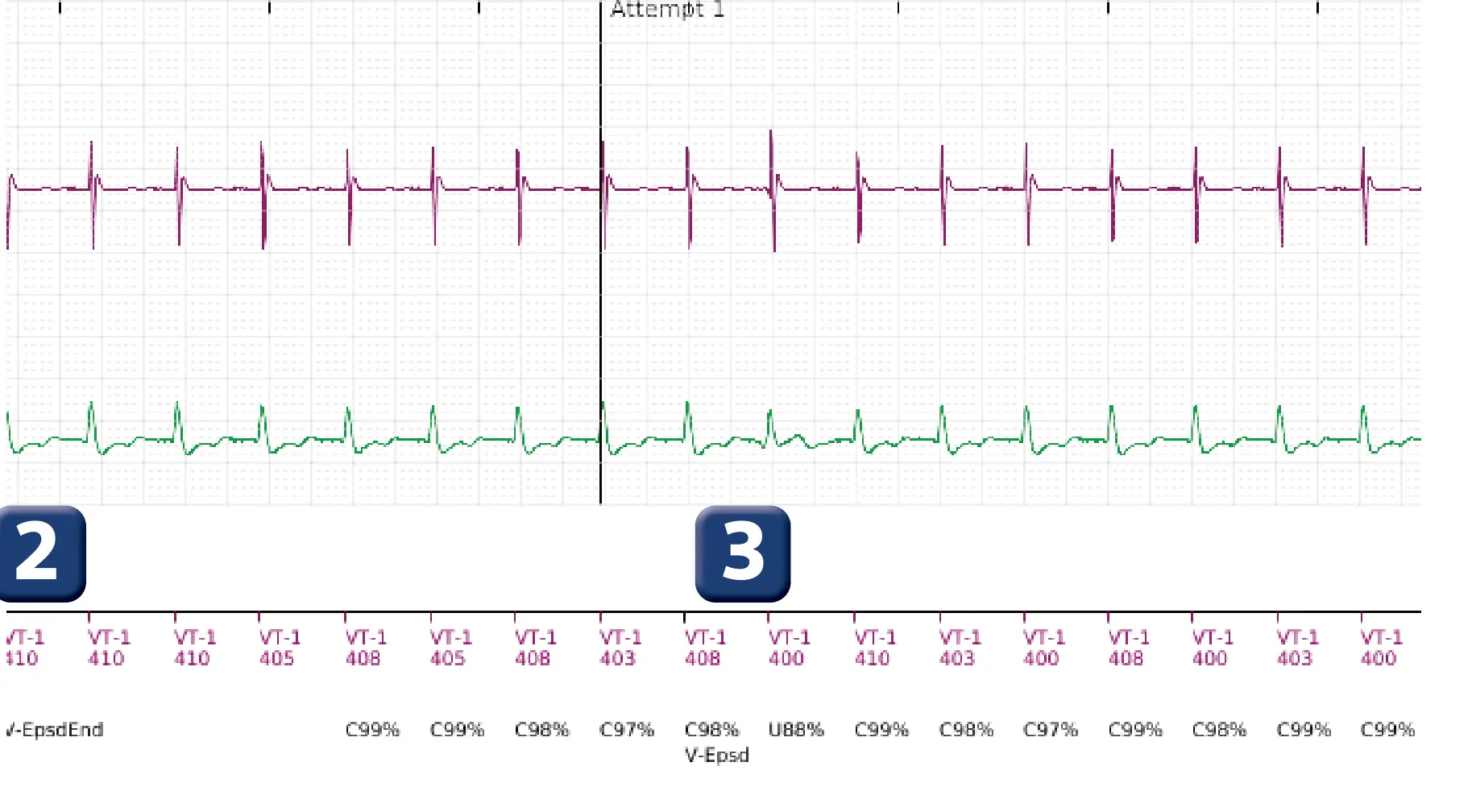 Boston Scientific ICD electrogram, segment 2 of 6 — Single-chamber discrimination, Rhythm ID and sinus tachycardia