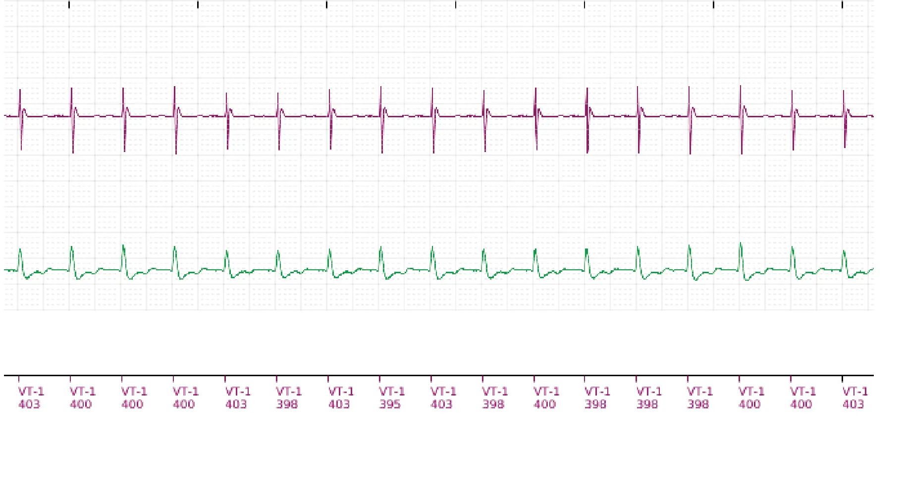 Boston Scientific ICD electrogram, segment 3 of 6 — Single-chamber discrimination, Rhythm ID and sinus tachycardia
