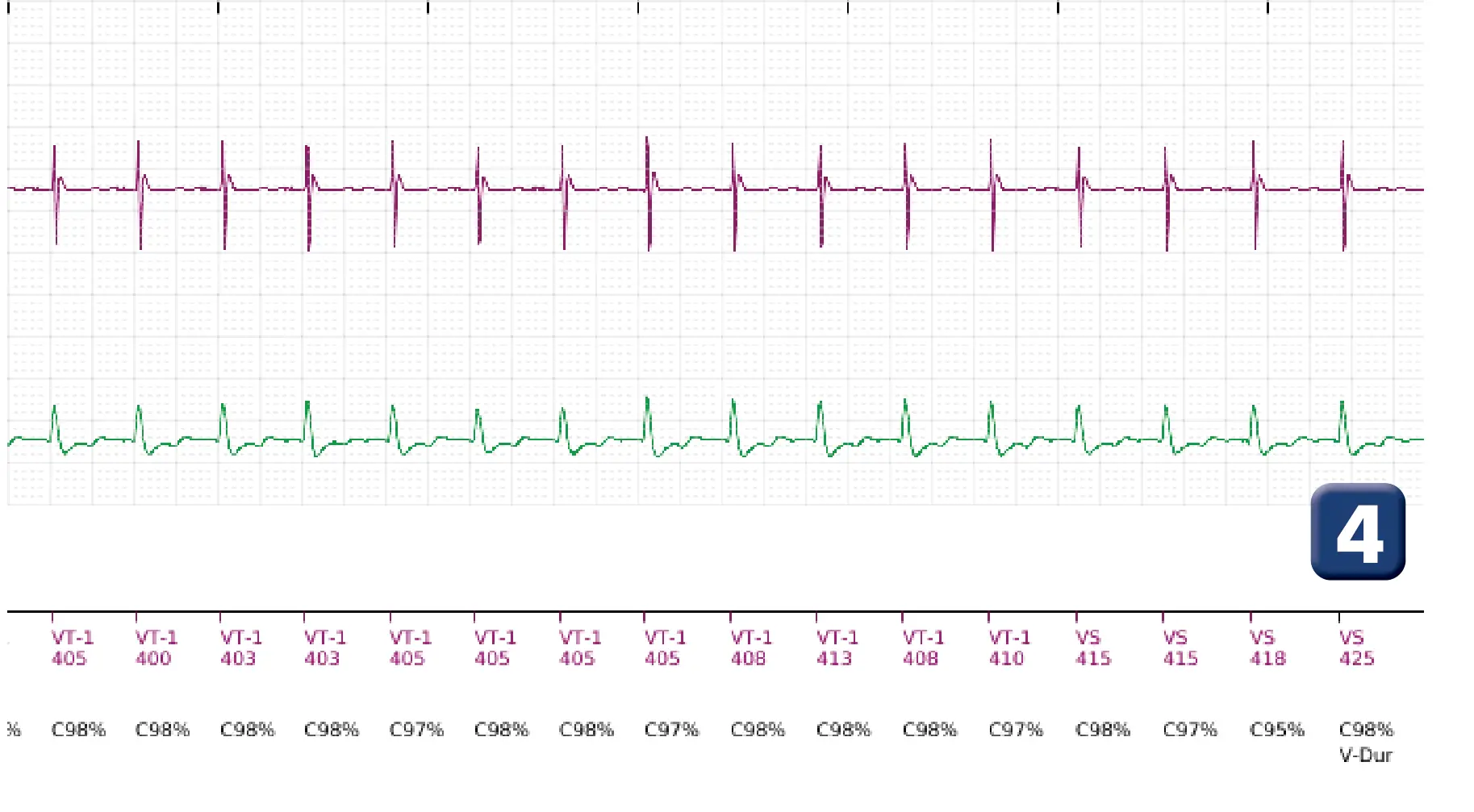 Boston Scientific ICD electrogram, segment 5 of 6 — Single-chamber discrimination, Rhythm ID and sinus tachycardia