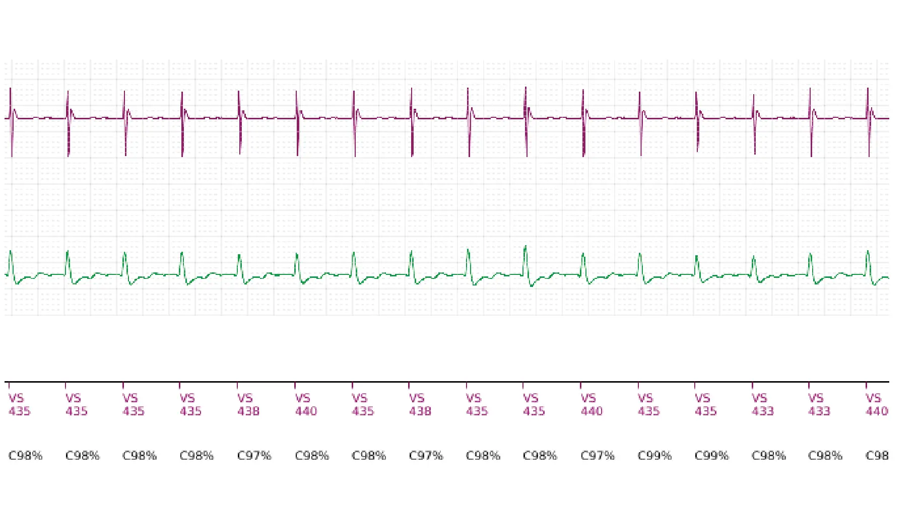 Boston Scientific ICD electrogram, segment 6 of 6 — Single-chamber discrimination, Rhythm ID and sinus tachycardia