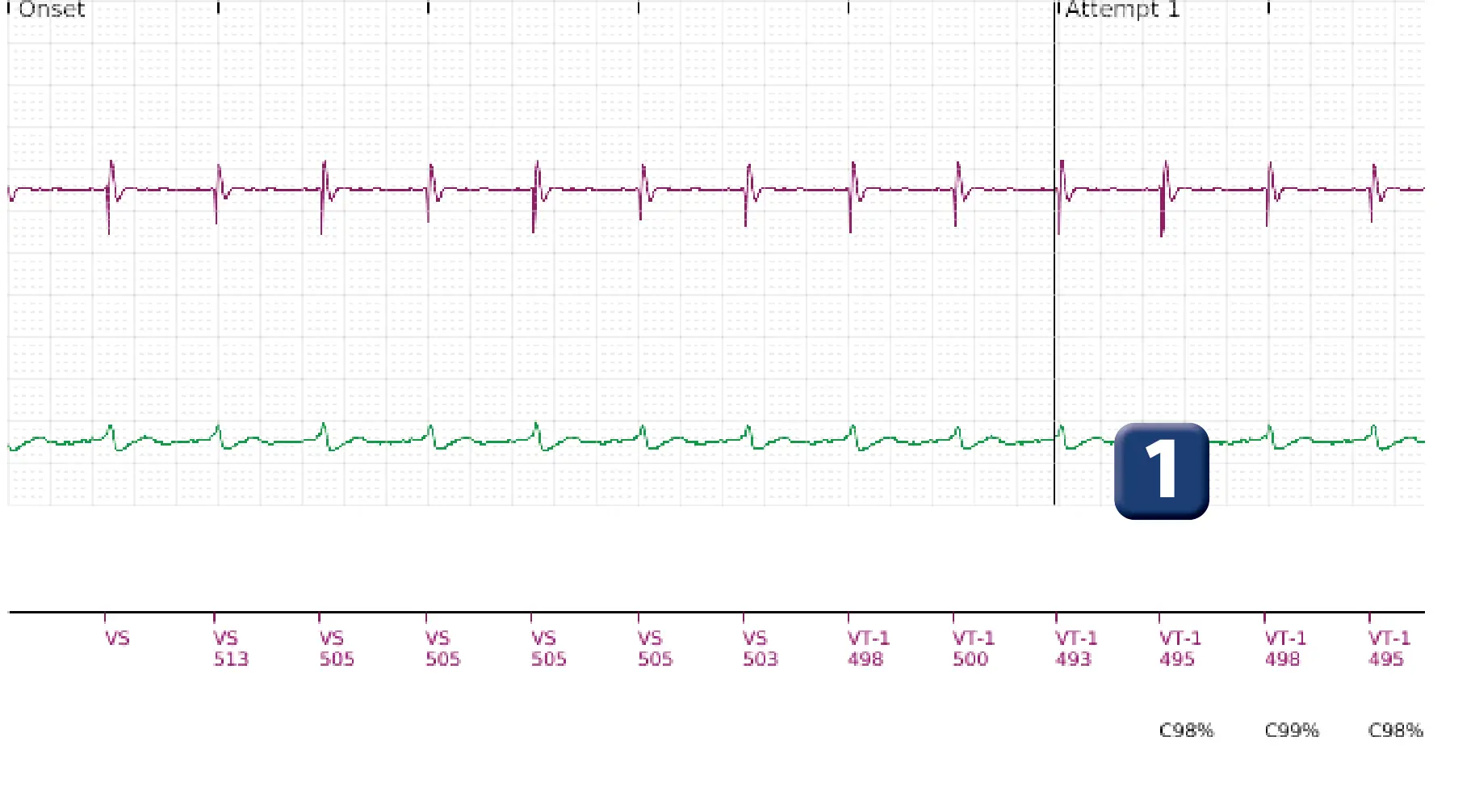 Boston Scientific ICD electrogram, segment 1 of 11 — Single-chamber discrimination, Rhythm ID and correlation percentage