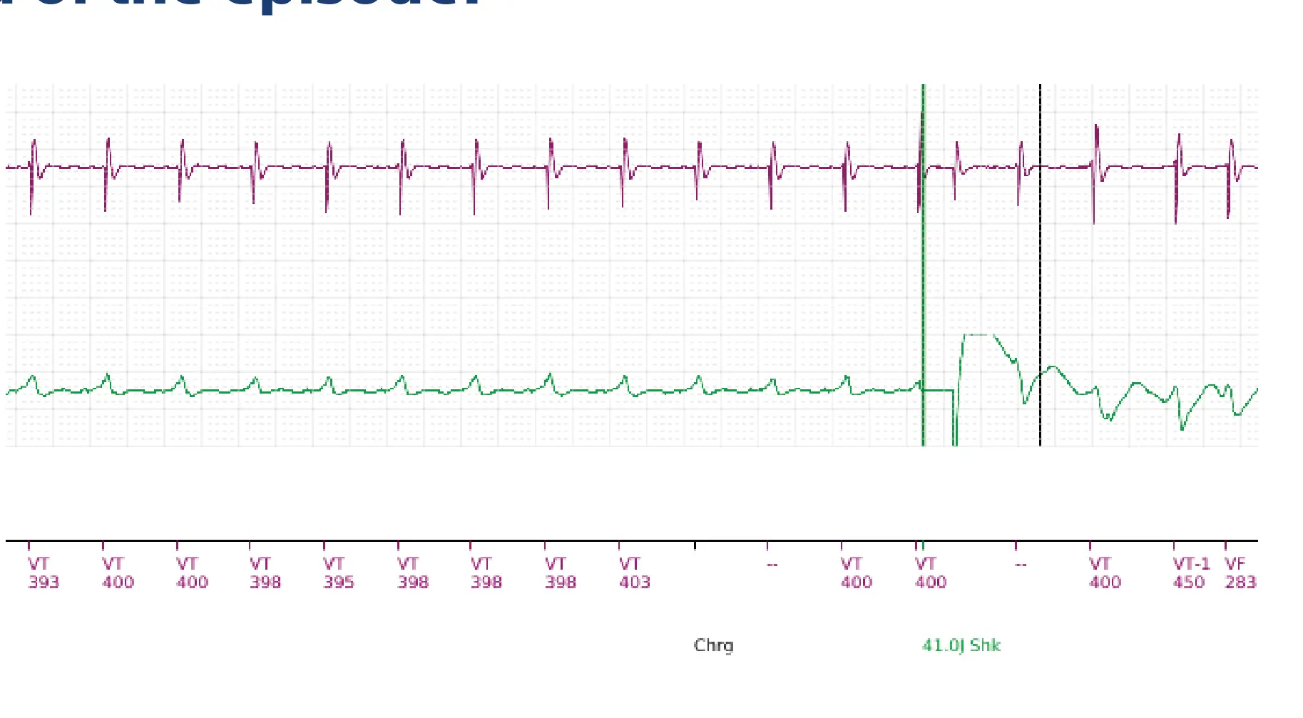 Boston Scientific ICD electrogram, segment 10 of 11 — Single-chamber discrimination, Rhythm ID and correlation percentage