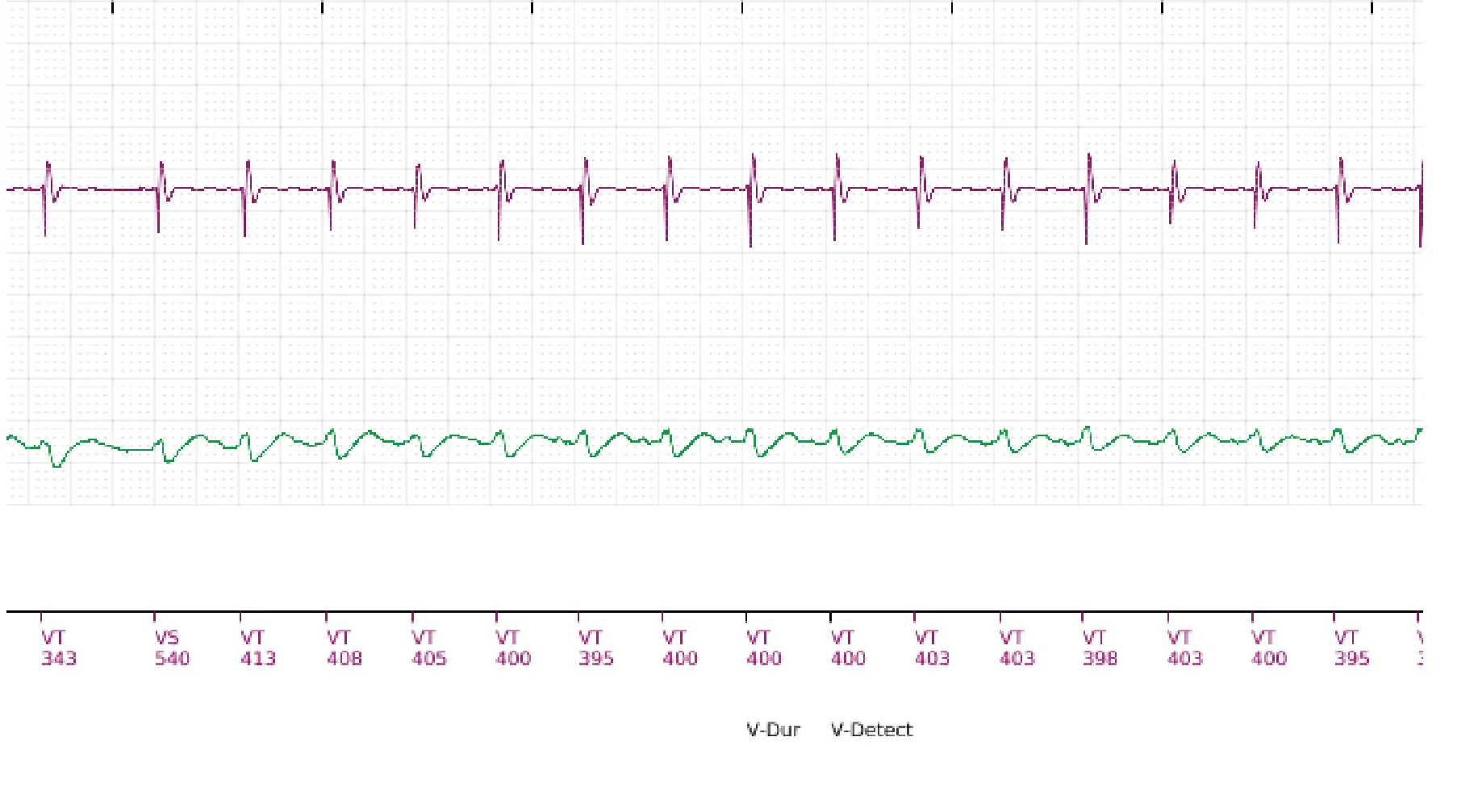 Boston Scientific ICD electrogram, segment 11 of 11 — Single-chamber discrimination, Rhythm ID and correlation percentage