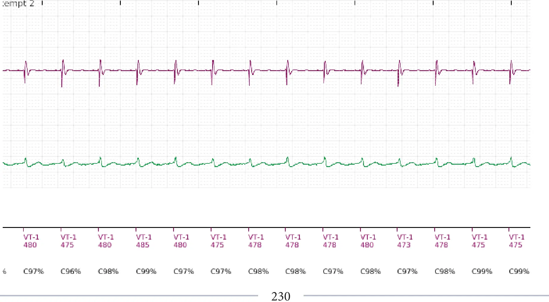 Boston Scientific ICD electrogram, segment 3 of 11 — Single-chamber discrimination, Rhythm ID and correlation percentage