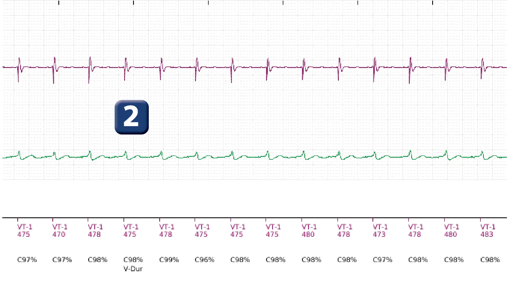 Boston Scientific ICD electrogram, segment 4 of 11 — Single-chamber discrimination, Rhythm ID and correlation percentage