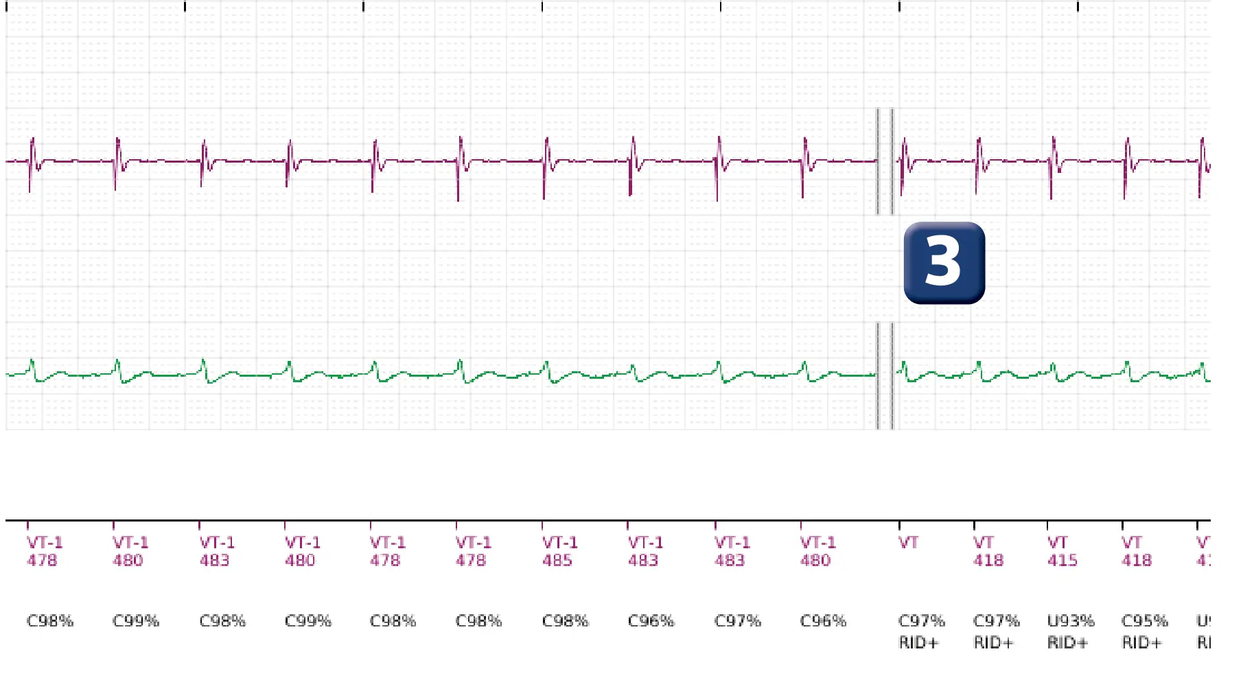 Boston Scientific ICD electrogram, segment 5 of 11 — Single-chamber discrimination, Rhythm ID and correlation percentage