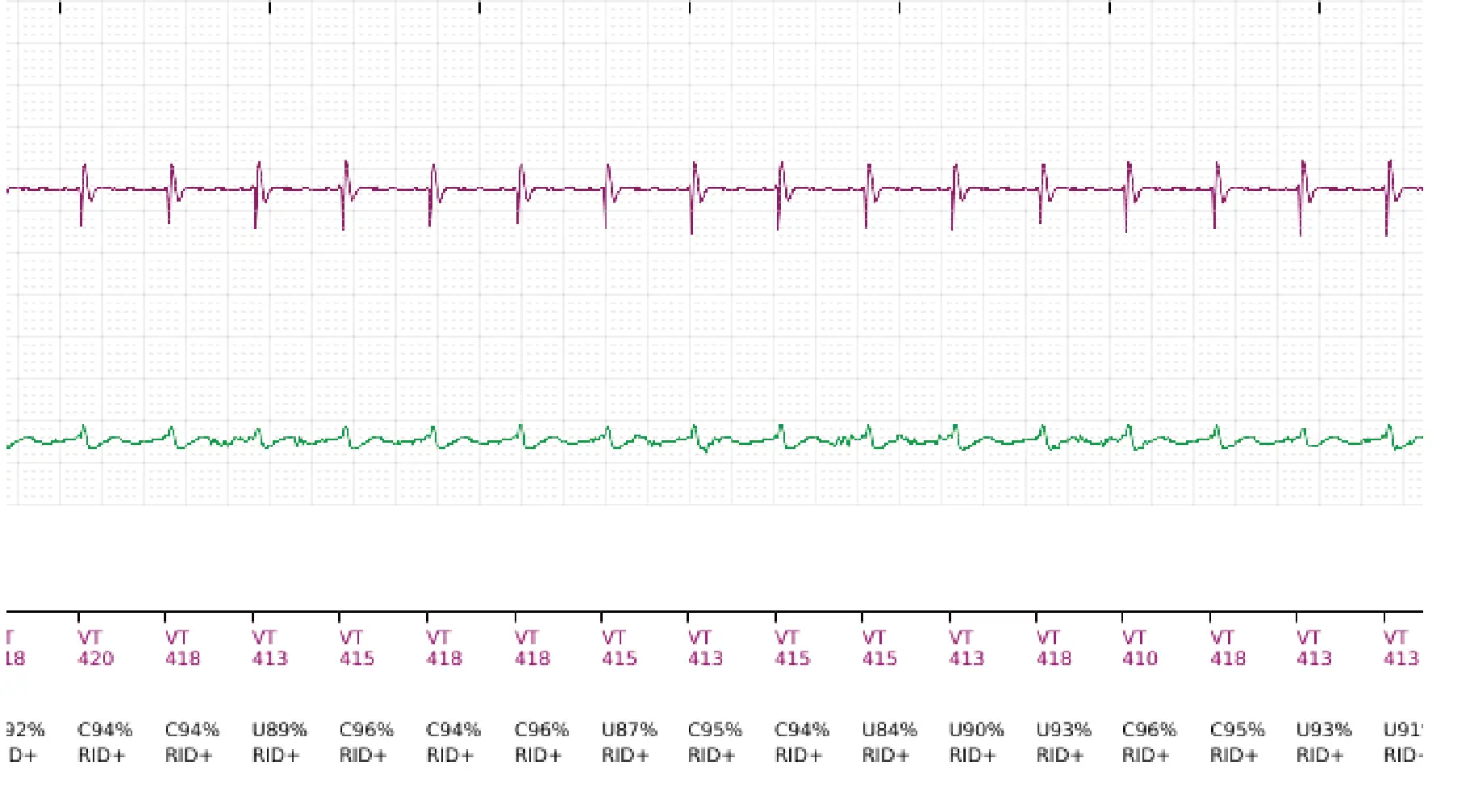 Boston Scientific ICD electrogram, segment 6 of 11 — Single-chamber discrimination, Rhythm ID and correlation percentage
