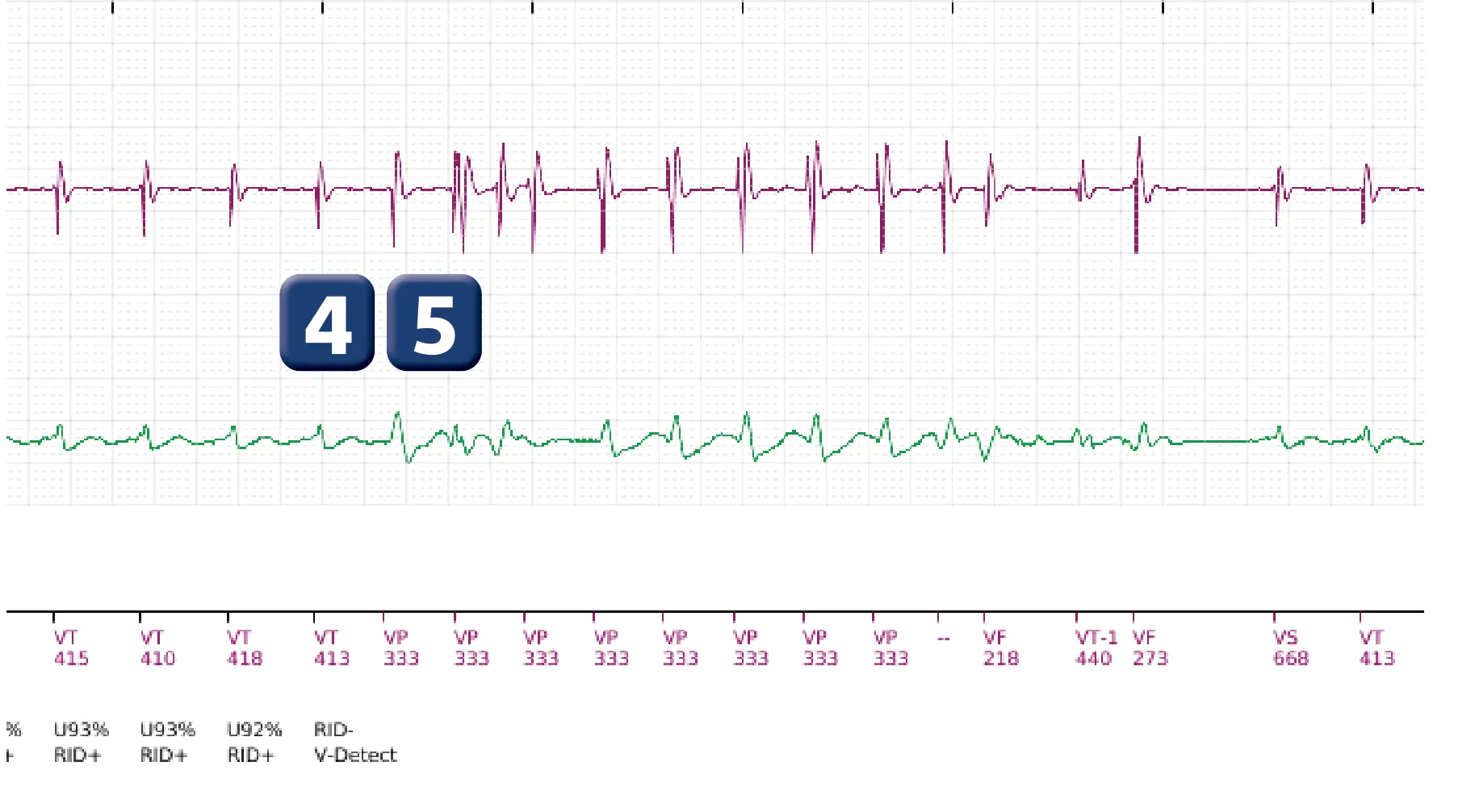 Boston Scientific ICD electrogram, segment 7 of 11 — Single-chamber discrimination, Rhythm ID and correlation percentage
