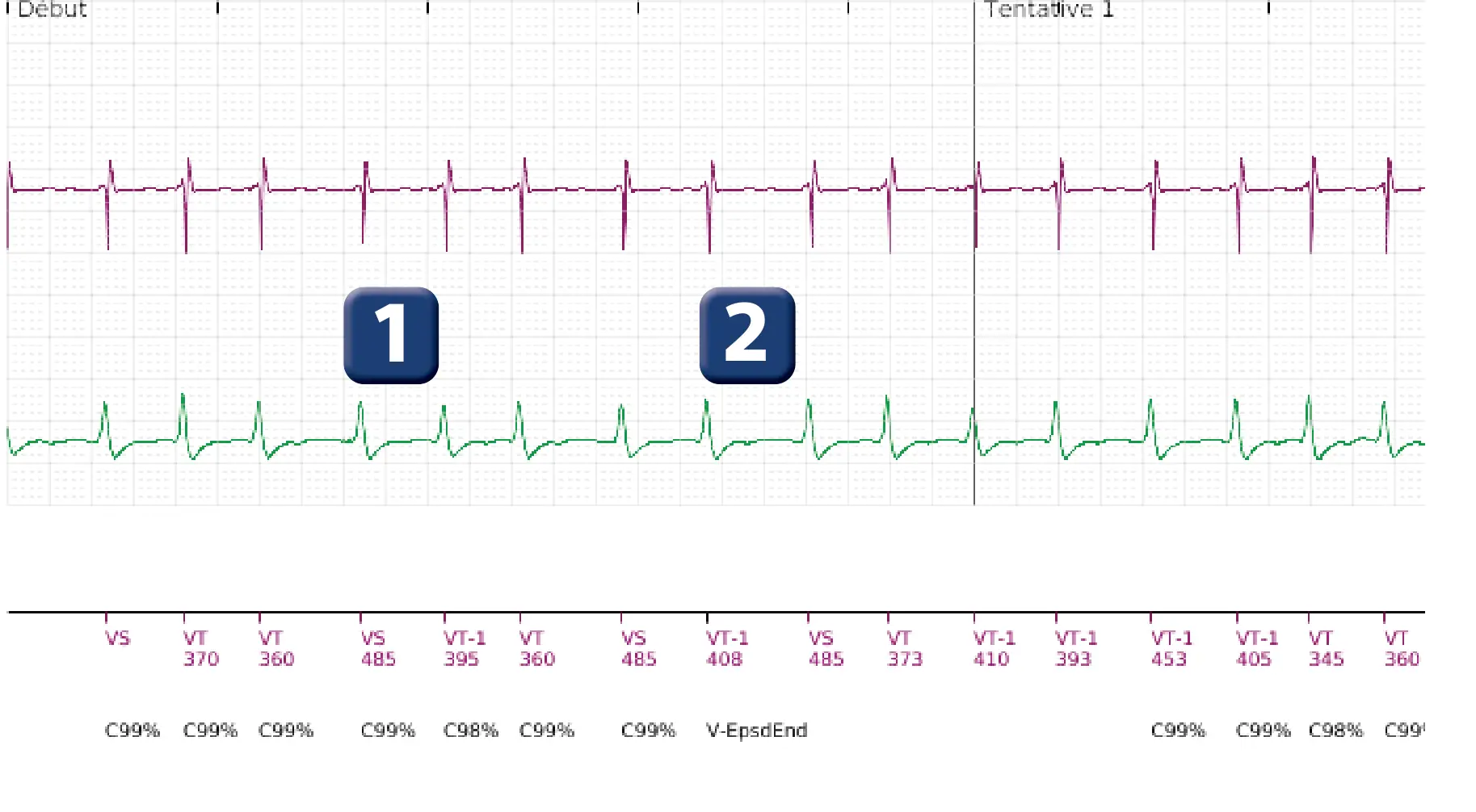 Boston Scientific ICD electrogram, segment 1 of 18 — Single-chamber discrimination, Rhythm ID and SRD
