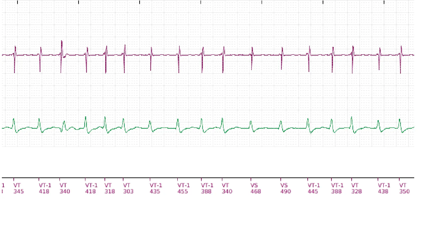 Boston Scientific ICD electrogram, segment 10 of 18 — Single-chamber discrimination, Rhythm ID and SRD