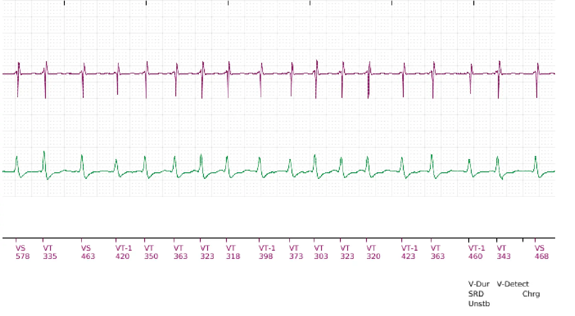 Boston Scientific ICD electrogram, segment 12 of 18 — Single-chamber discrimination, Rhythm ID and SRD