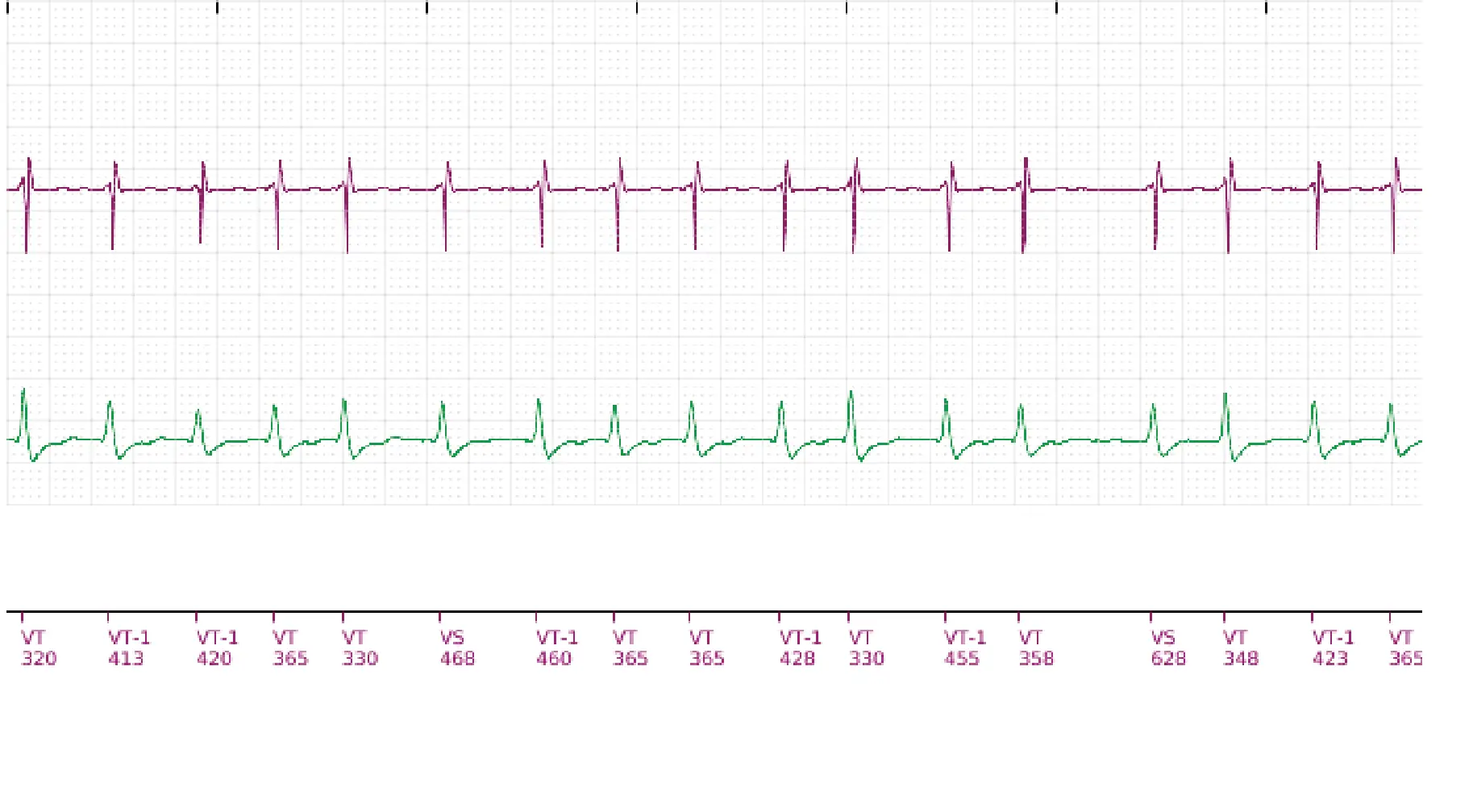 Boston Scientific ICD electrogram, segment 13 of 18 — Single-chamber discrimination, Rhythm ID and SRD