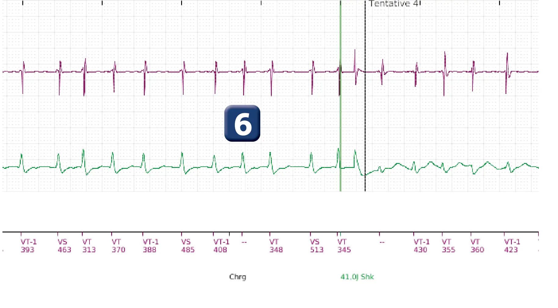 Boston Scientific ICD electrogram, segment 14 of 18 — Single-chamber discrimination, Rhythm ID and SRD