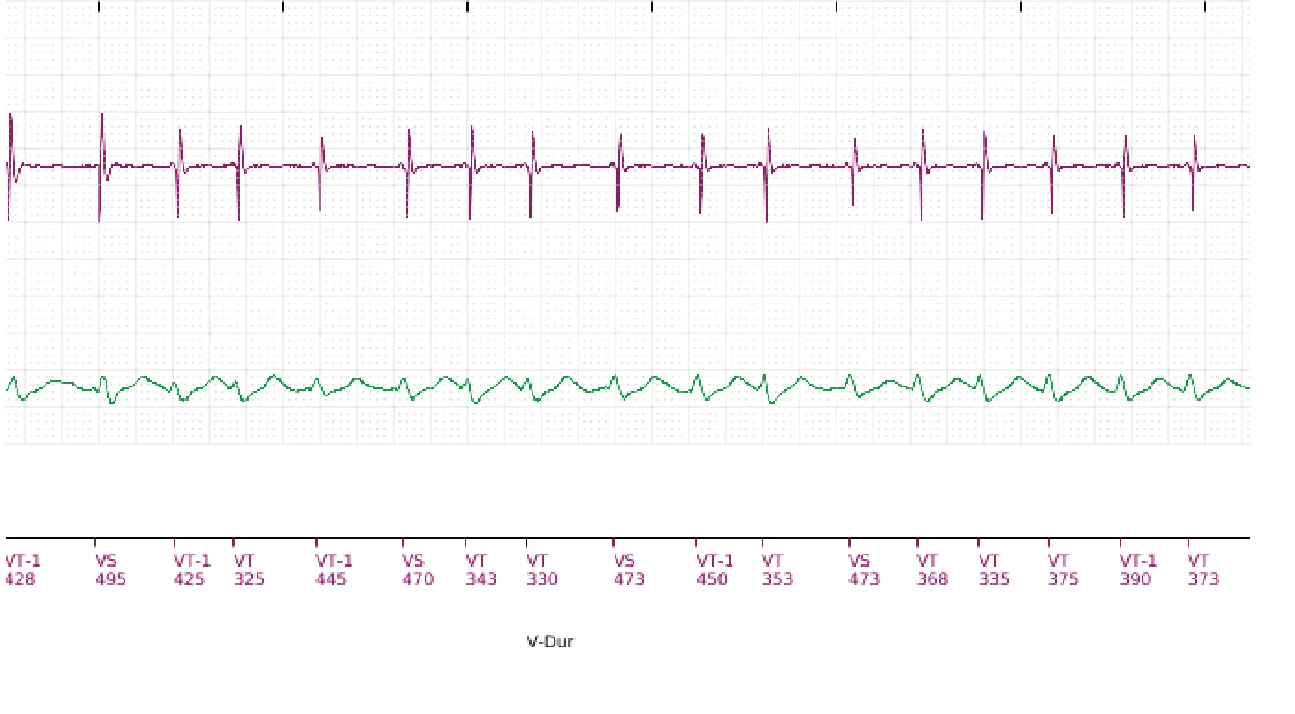 Boston Scientific ICD electrogram, segment 15 of 18 — Single-chamber discrimination, Rhythm ID and SRD