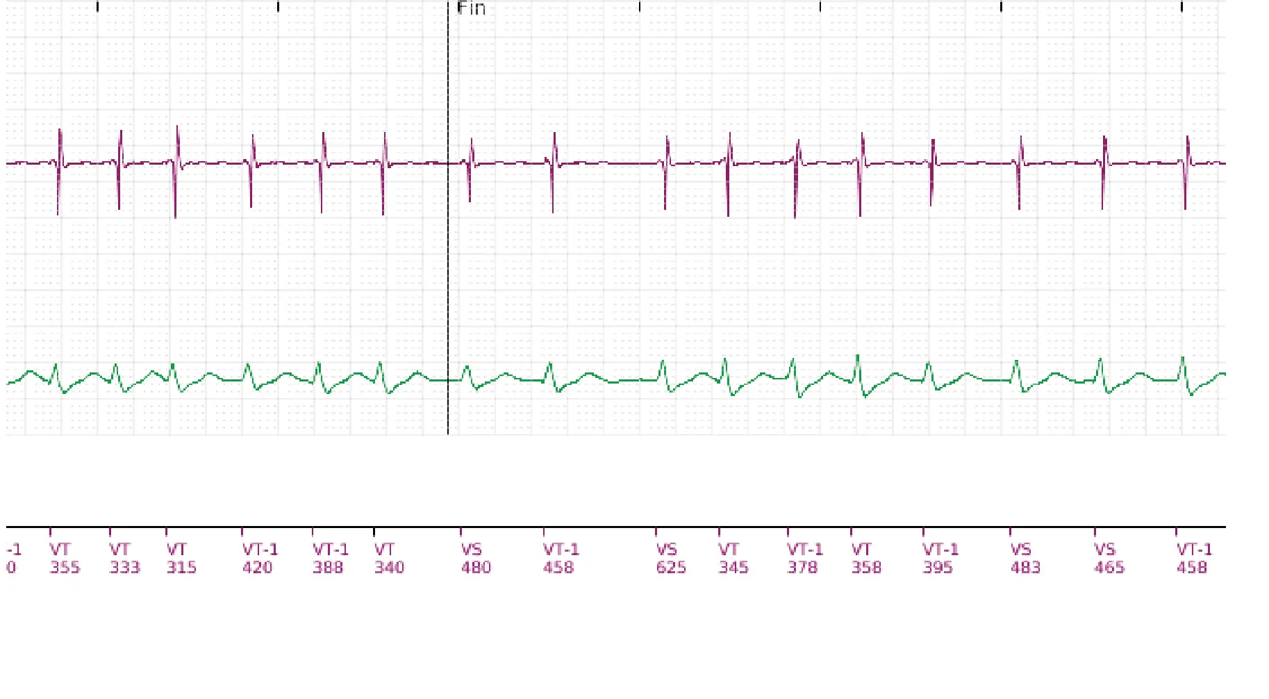 Boston Scientific ICD electrogram, segment 17 of 18 — Single-chamber discrimination, Rhythm ID and SRD