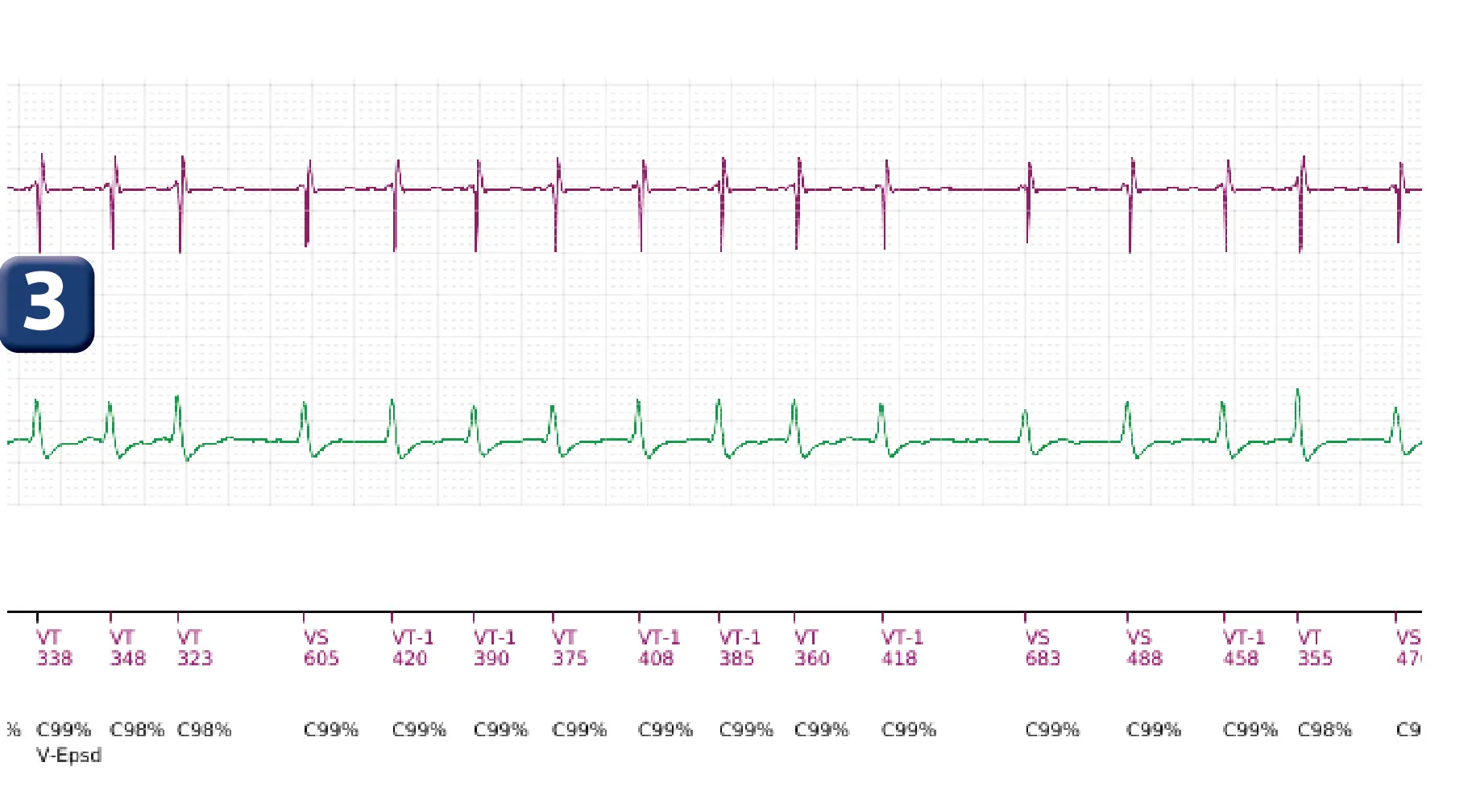 Boston Scientific ICD electrogram, segment 2 of 18 — Single-chamber discrimination, Rhythm ID and SRD