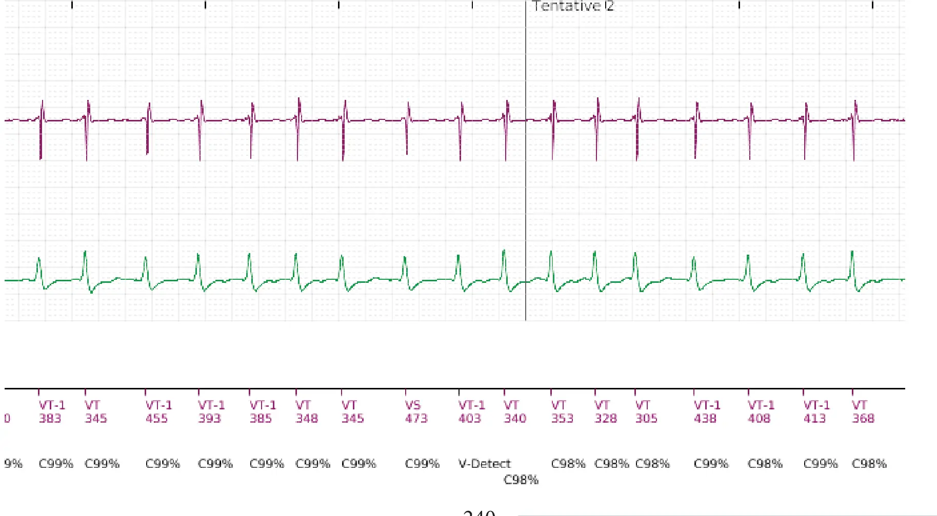 Boston Scientific ICD electrogram, segment 3 of 18 — Single-chamber discrimination, Rhythm ID and SRD