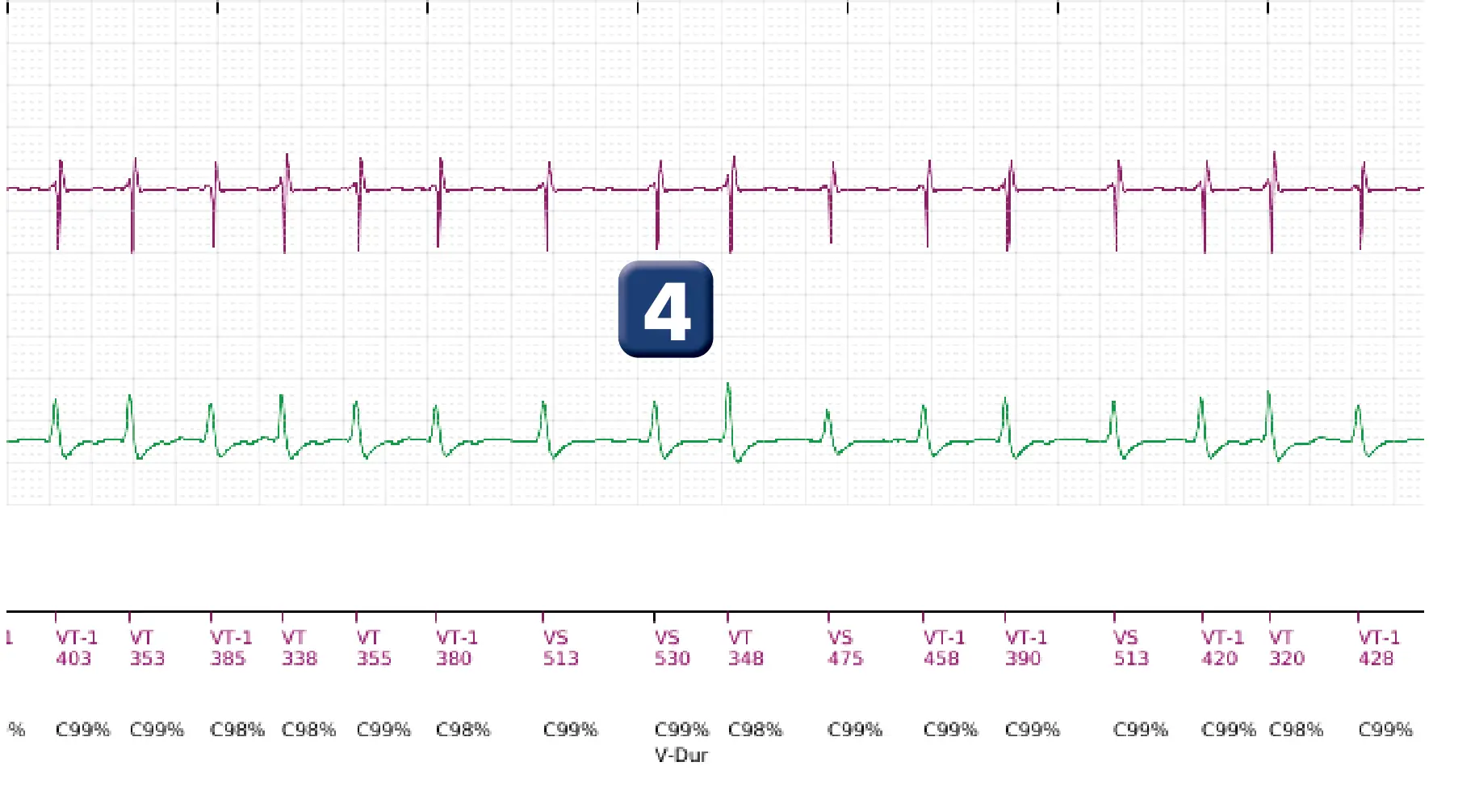 Boston Scientific ICD electrogram, segment 5 of 18 — Single-chamber discrimination, Rhythm ID and SRD