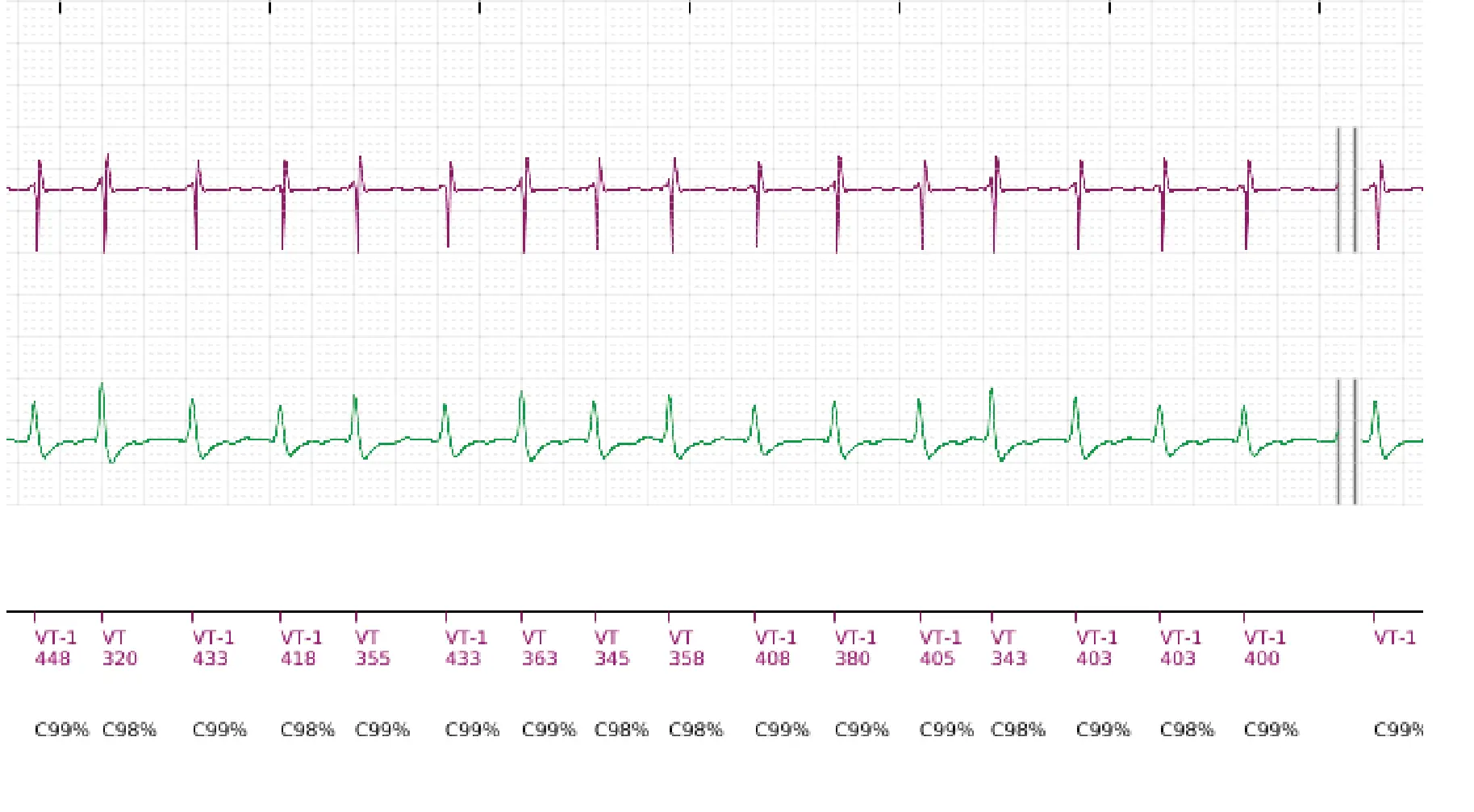 Boston Scientific ICD electrogram, segment 6 of 18 — Single-chamber discrimination, Rhythm ID and SRD