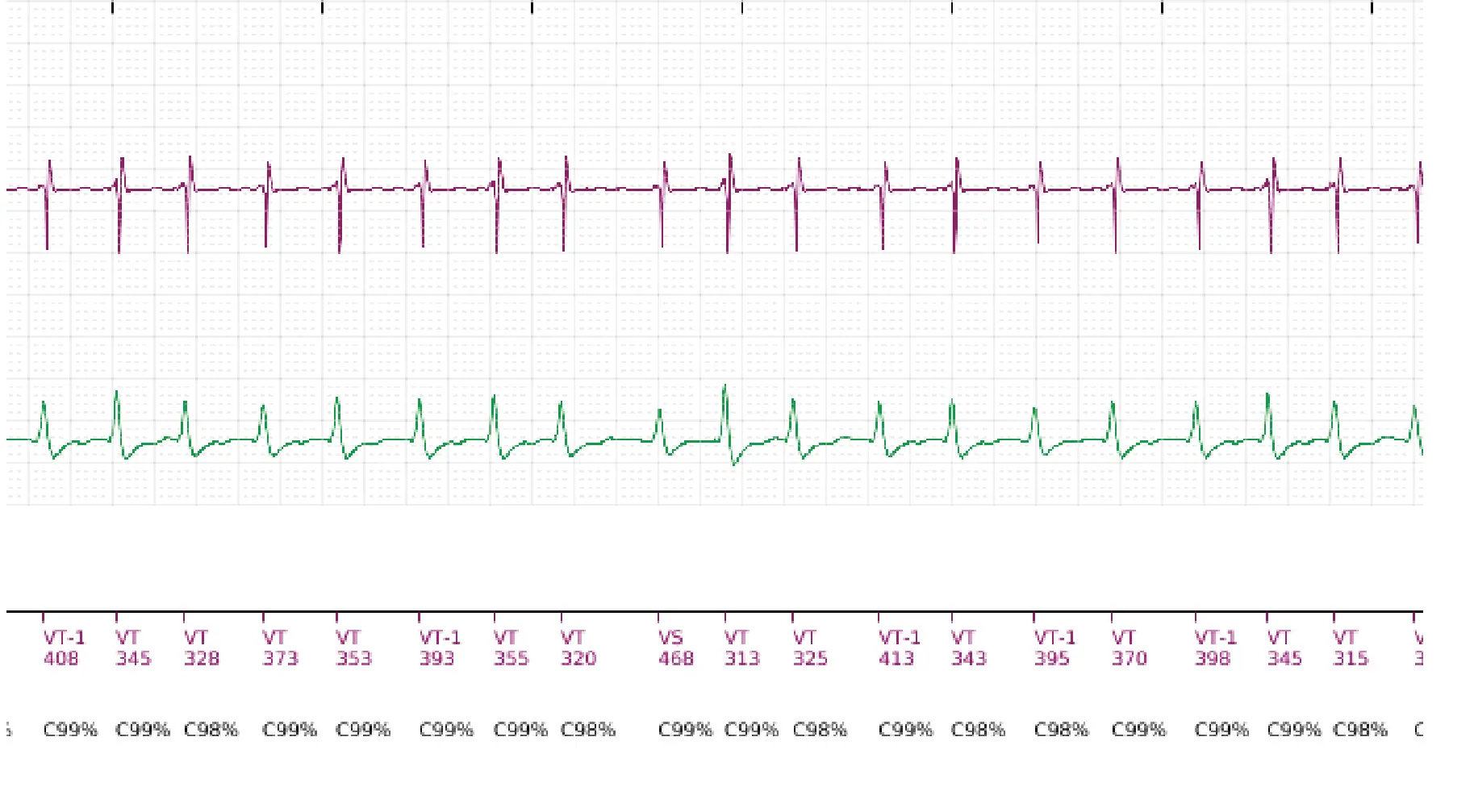 Boston Scientific ICD electrogram, segment 7 of 18 — Single-chamber discrimination, Rhythm ID and SRD
