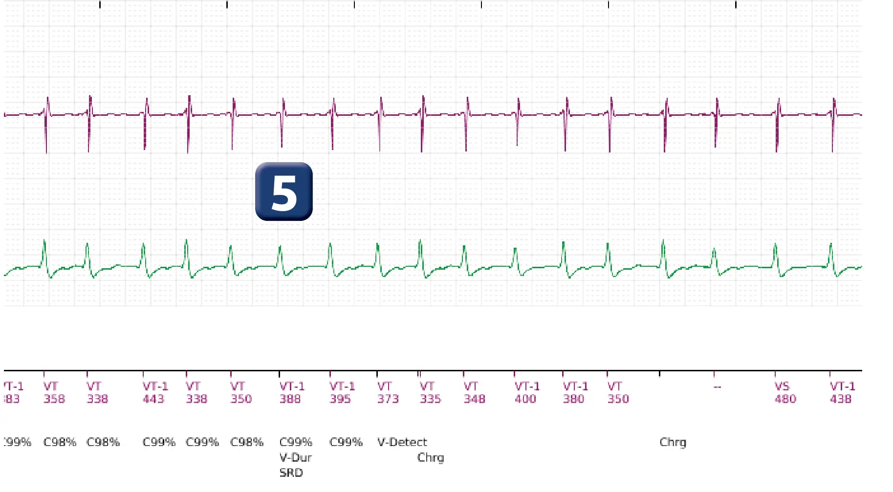 Boston Scientific ICD electrogram, segment 8 of 18 — Single-chamber discrimination, Rhythm ID and SRD