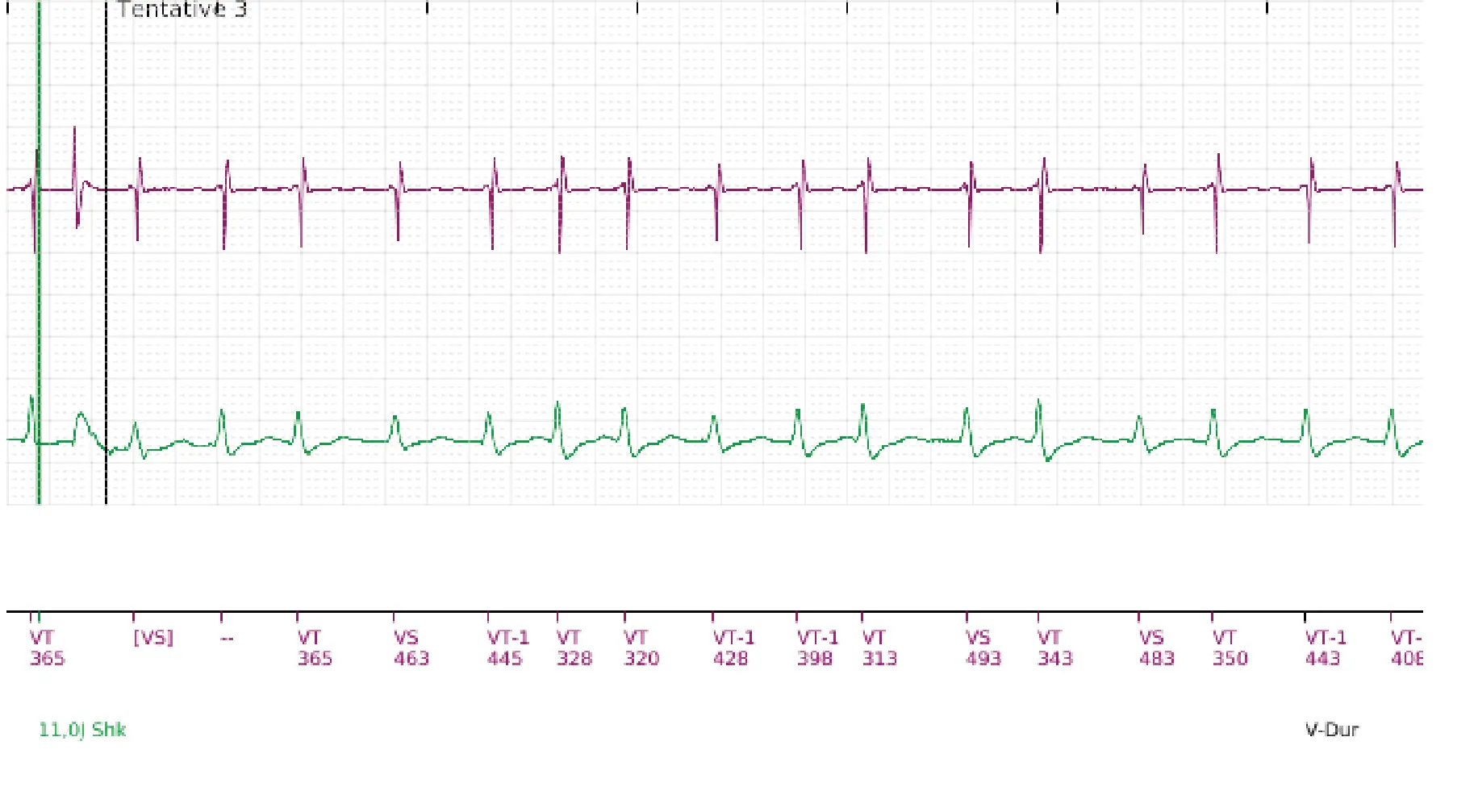 Boston Scientific ICD electrogram, segment 9 of 18 — Single-chamber discrimination, Rhythm ID and SRD