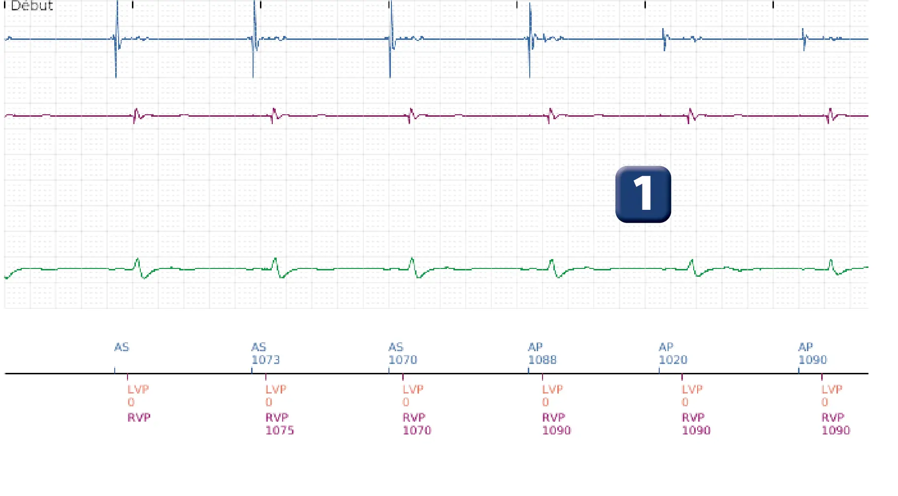 Boston Scientific ICD electrogram, segment 1 of 5 — Dual chamber discrimination and V>A