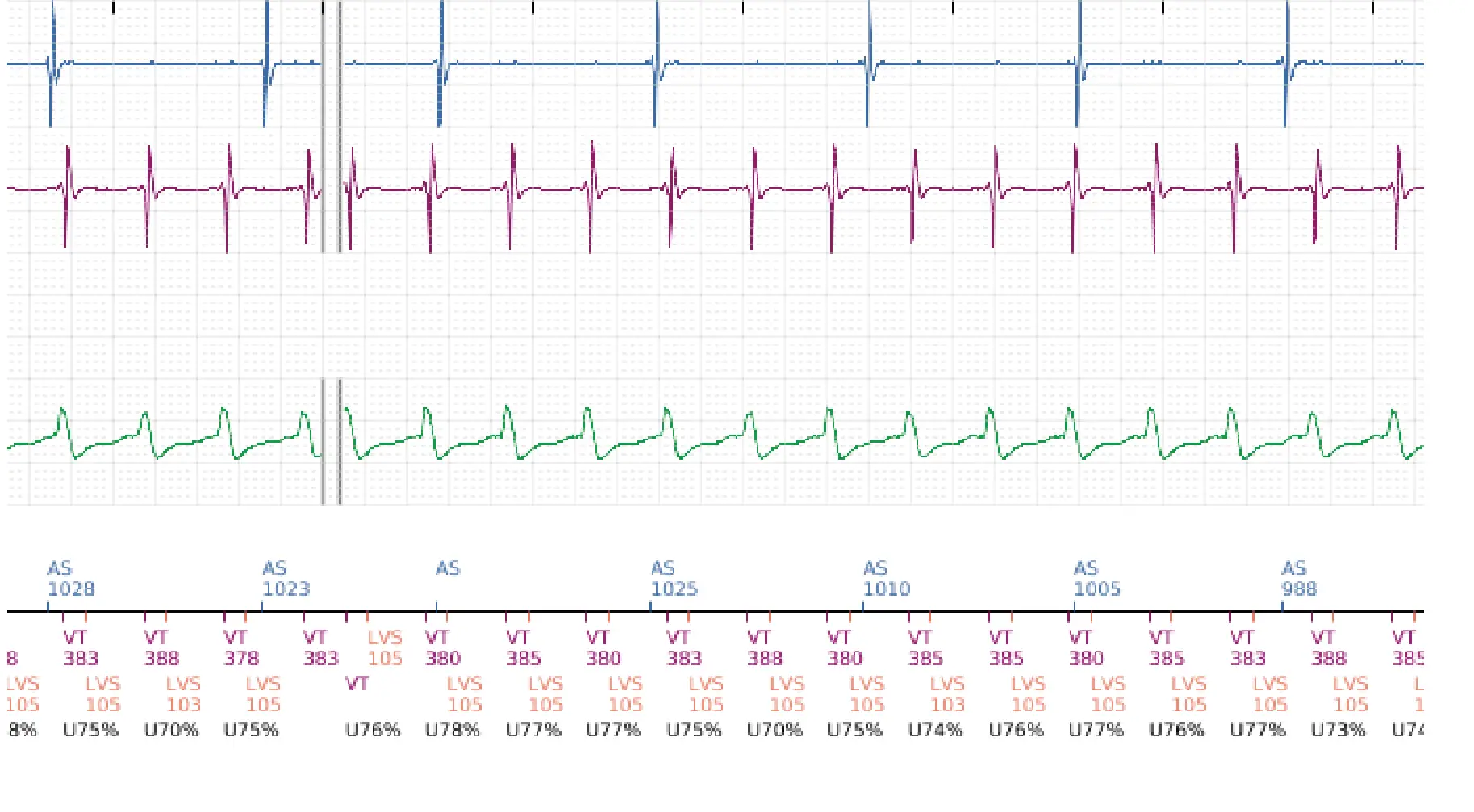 Boston Scientific ICD electrogram, segment 3 of 5 — Dual chamber discrimination and V>A