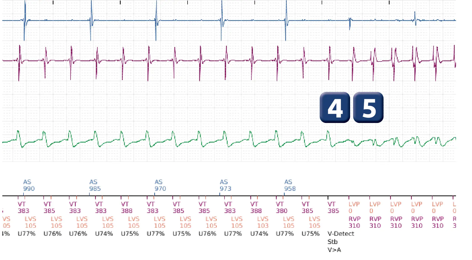 Boston Scientific ICD electrogram, segment 4 of 5 — Dual chamber discrimination and V>A