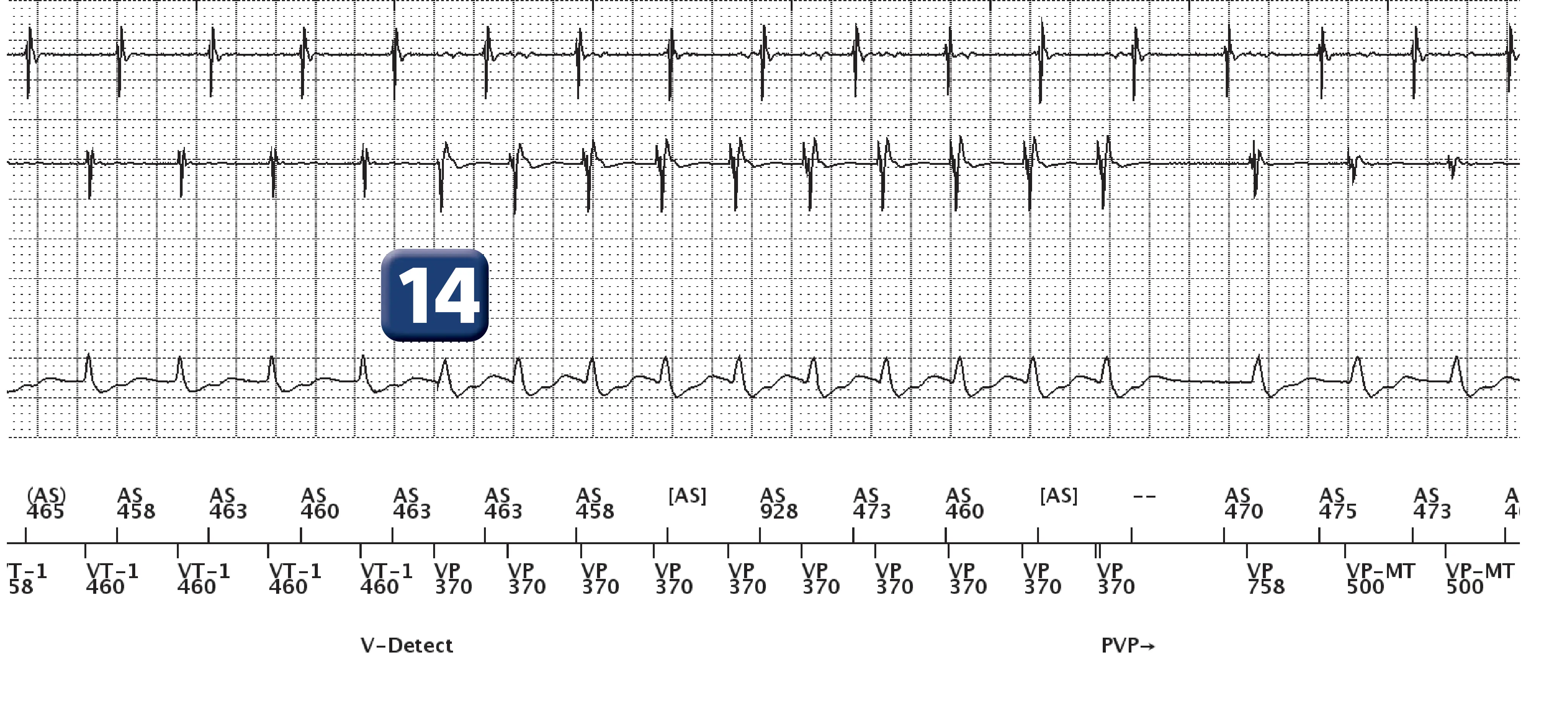 Boston Scientific ICD electrogram, segment 10 of 13 — Dual-chamber discrimination, atrial refractory periods and V>A criterion