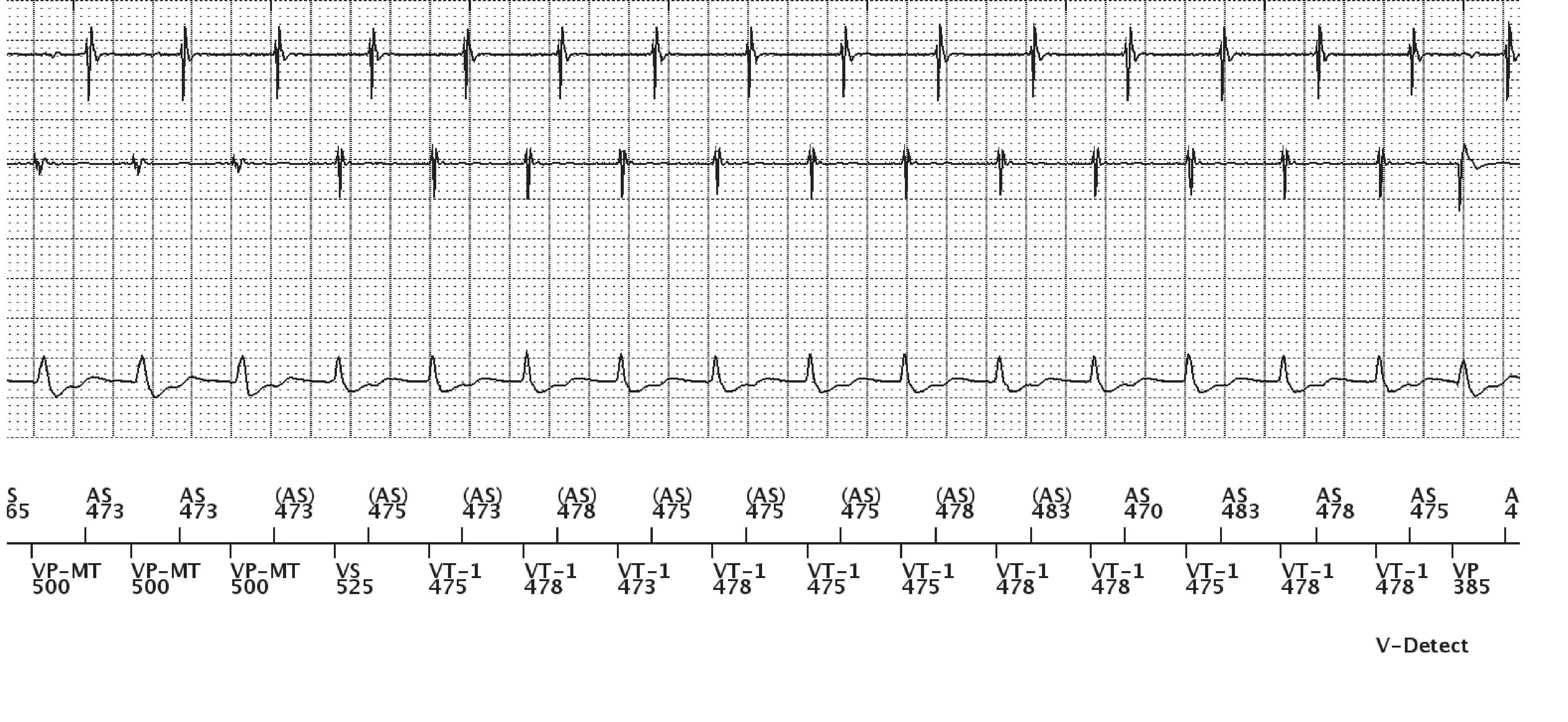 Boston Scientific ICD electrogram, segment 11 of 13 — Dual-chamber discrimination, atrial refractory periods and V>A criterion