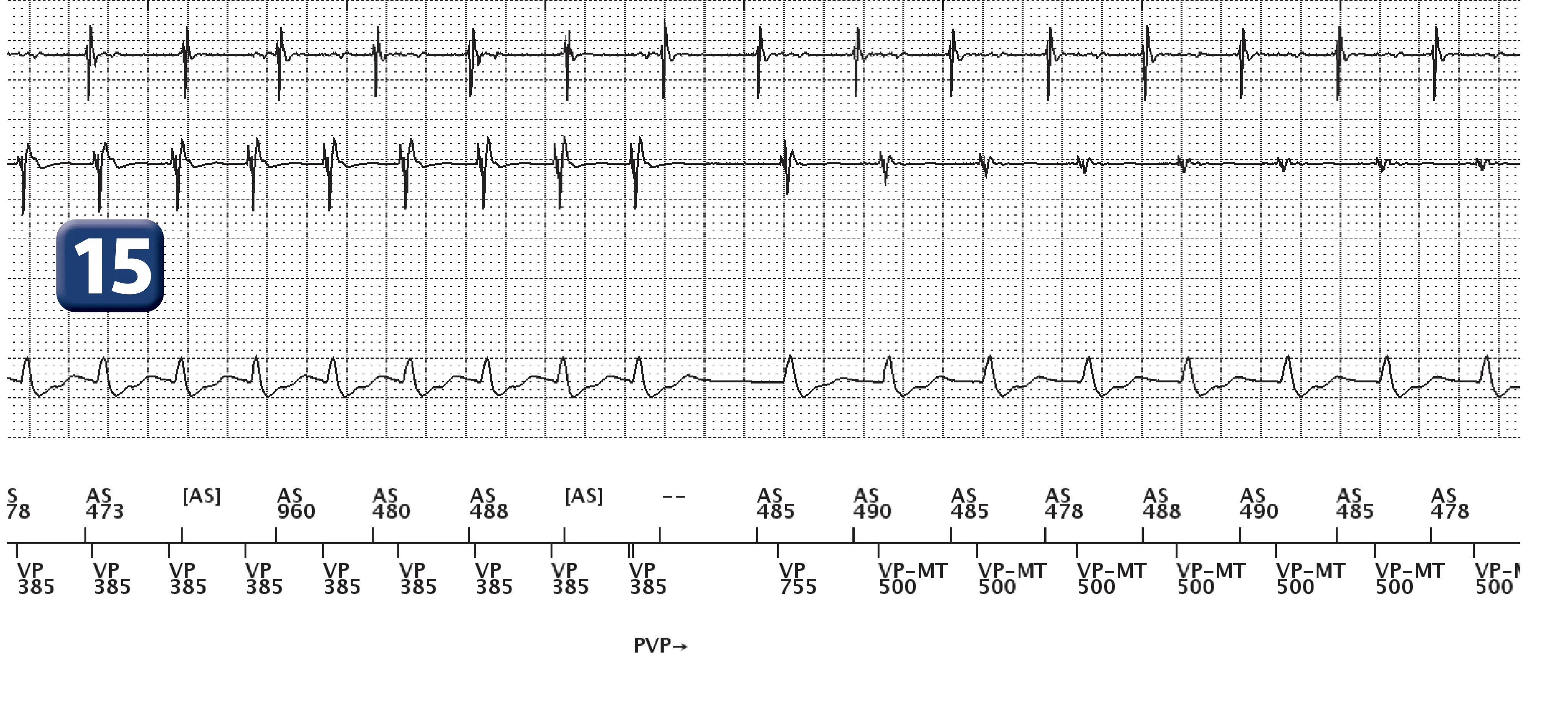 Boston Scientific ICD electrogram, segment 12 of 13 — Dual-chamber discrimination, atrial refractory periods and V>A criterion