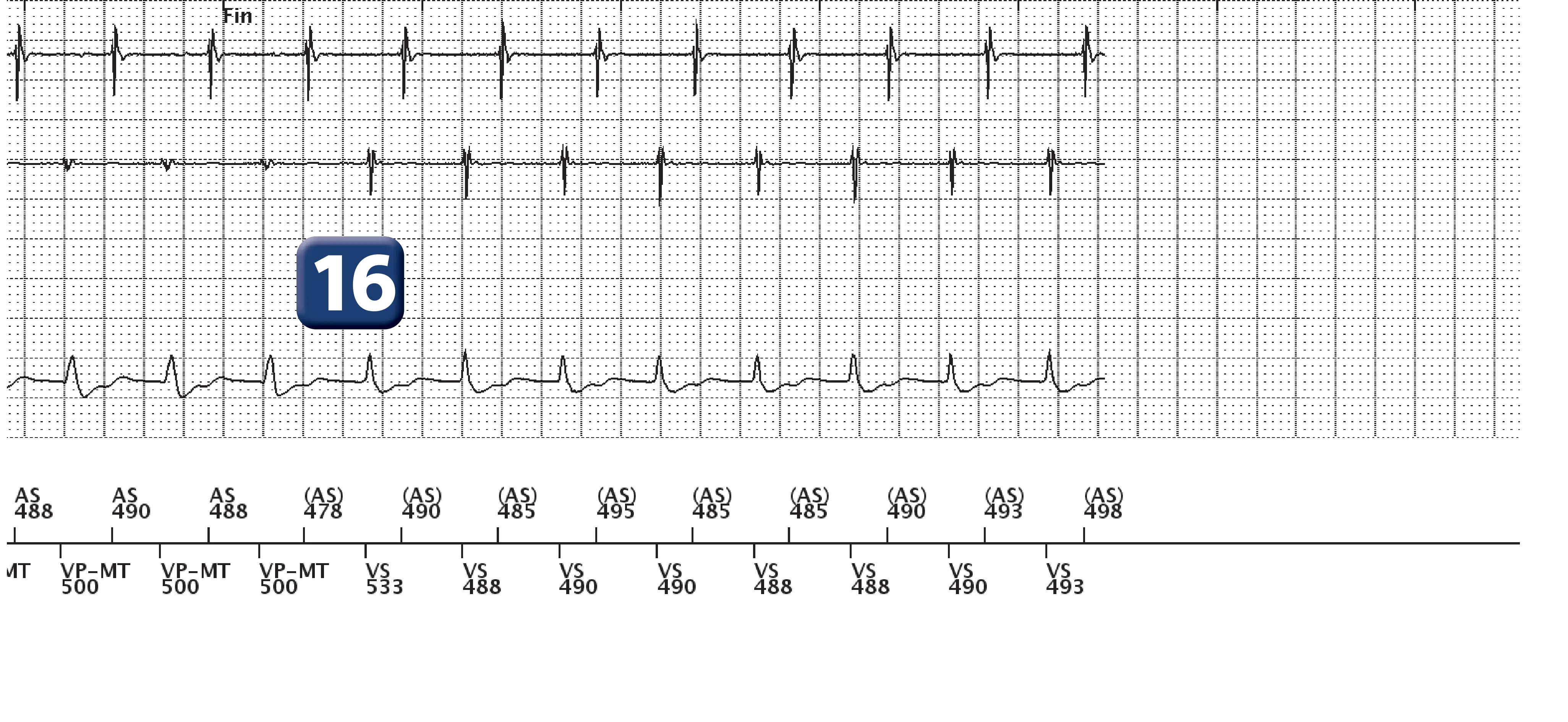 Boston Scientific ICD electrogram, segment 13 of 13 — Dual-chamber discrimination, atrial refractory periods and V>A criterion
