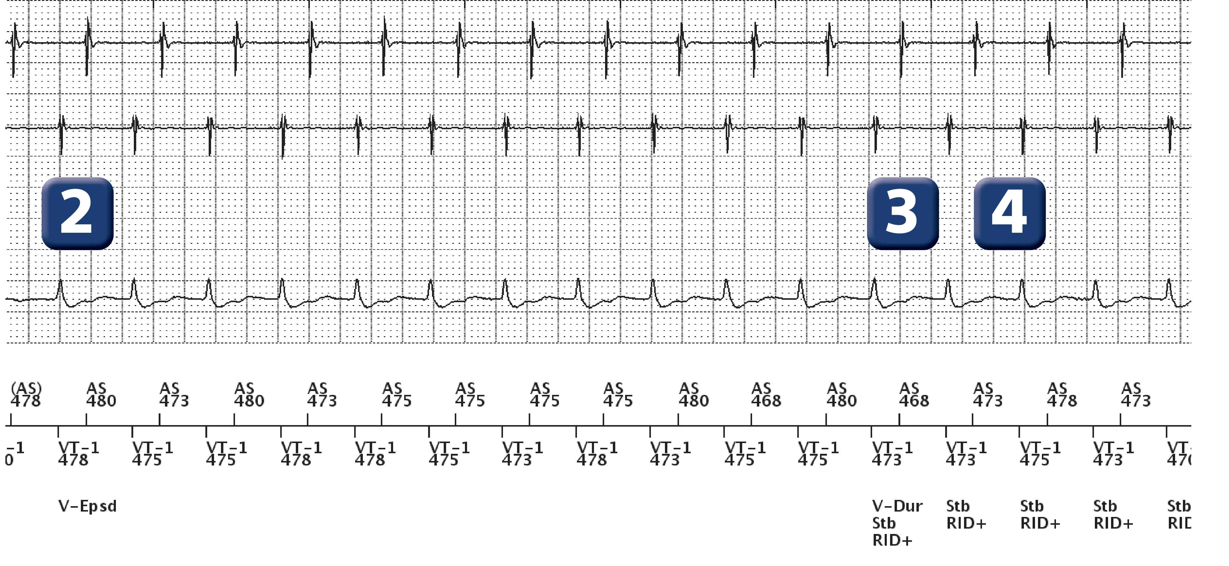 Boston Scientific ICD electrogram, segment 2 of 13 — Dual-chamber discrimination, atrial refractory periods and V>A criterion