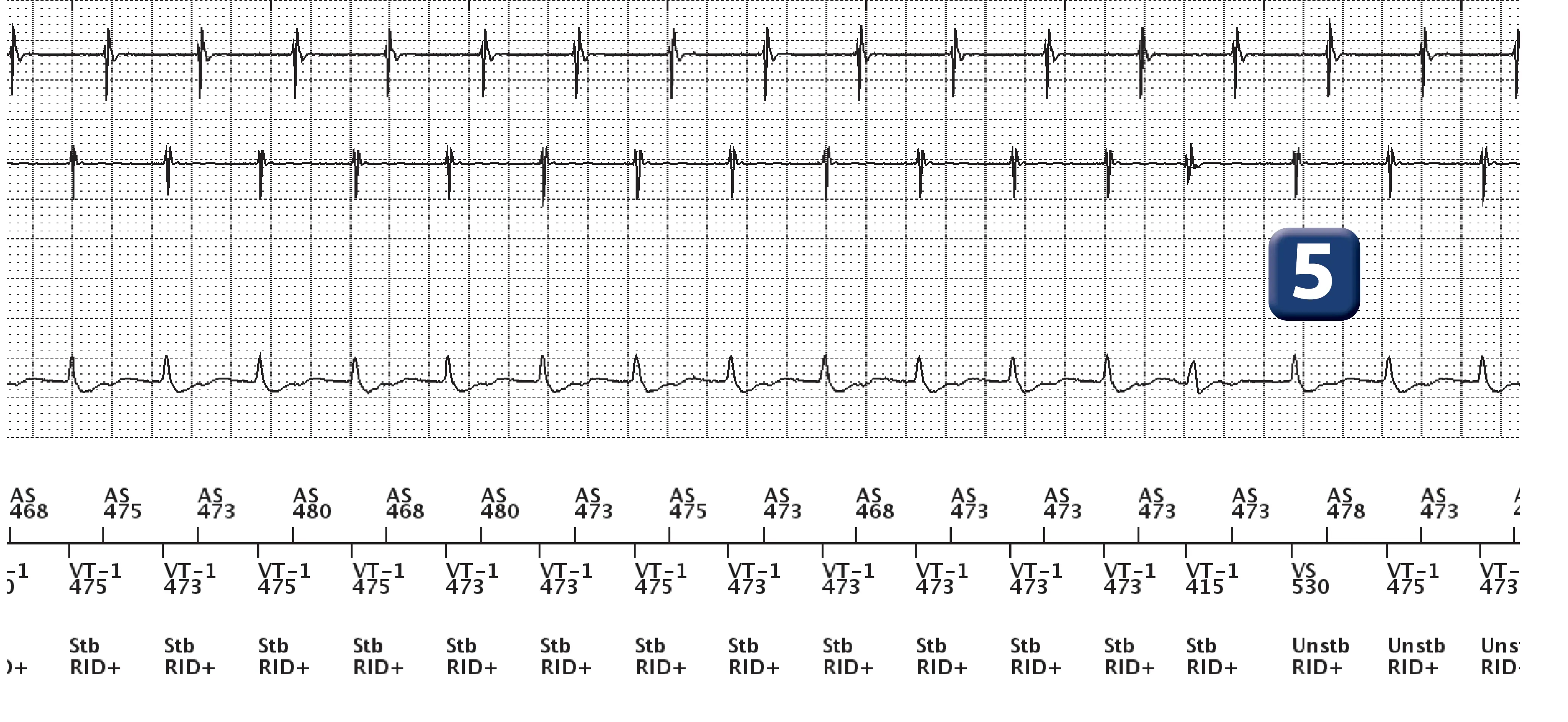 Boston Scientific ICD electrogram, segment 3 of 13 — Dual-chamber discrimination, atrial refractory periods and V>A criterion