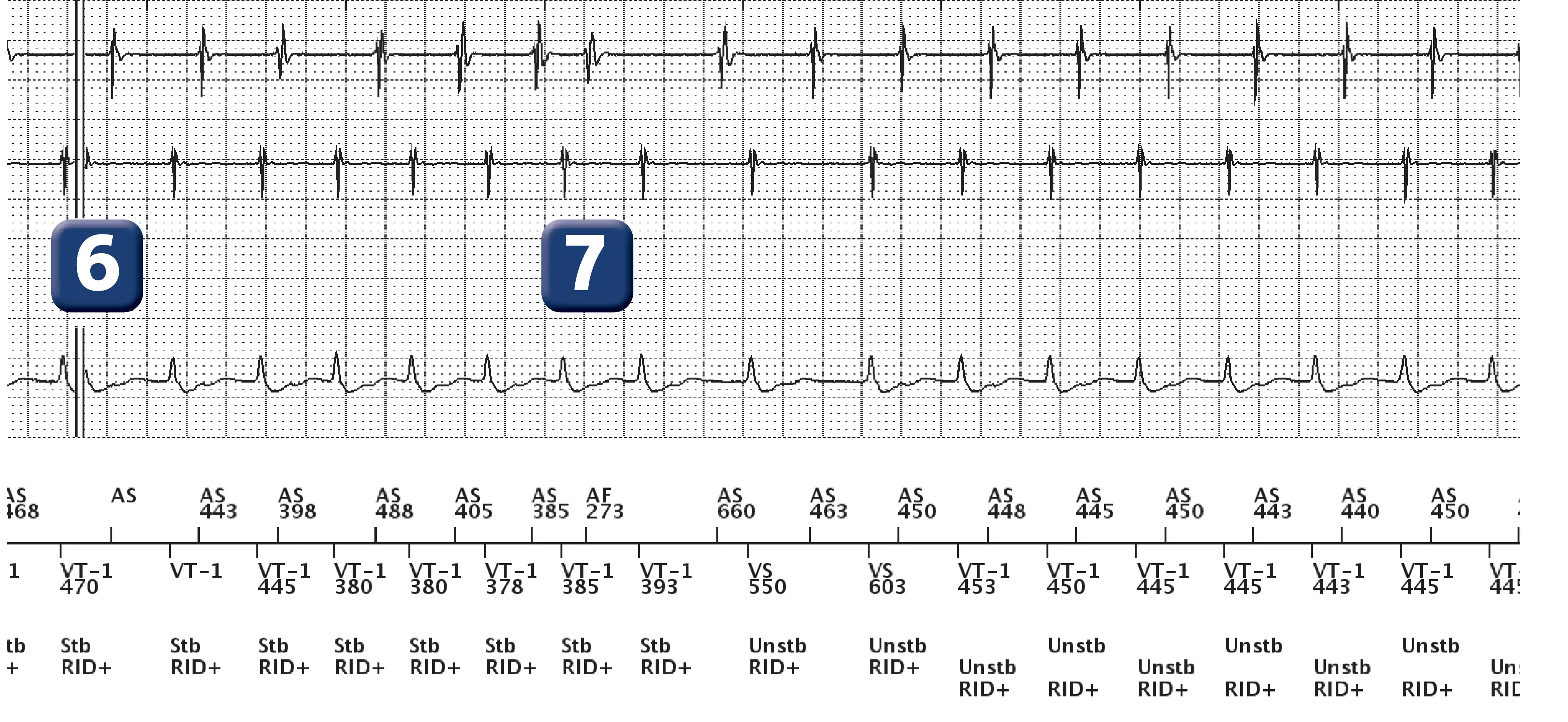 Boston Scientific ICD electrogram, segment 4 of 13 — Dual-chamber discrimination, atrial refractory periods and V>A criterion