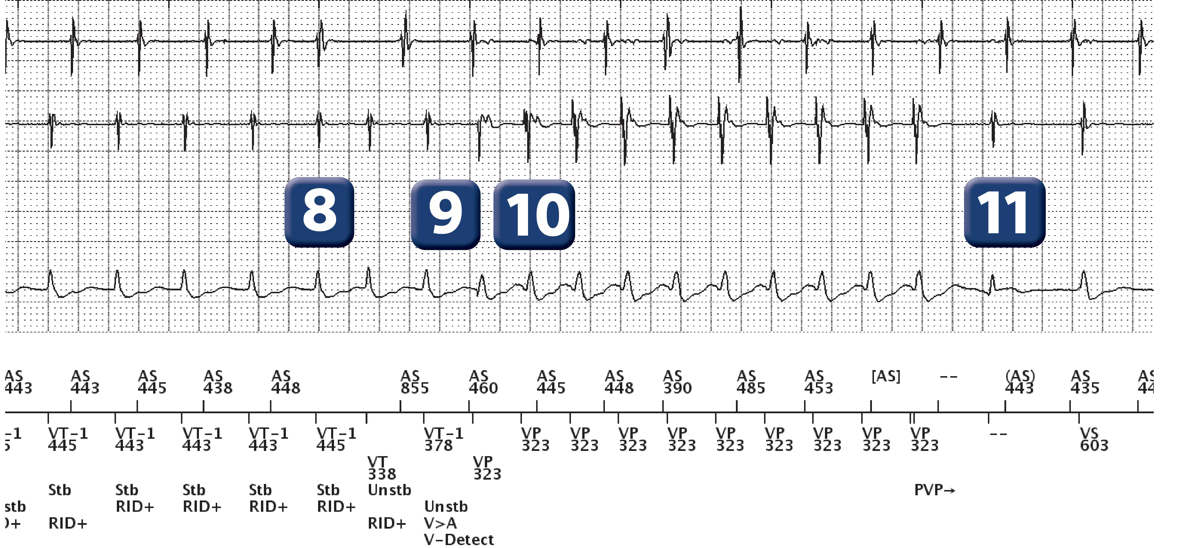Boston Scientific ICD electrogram, segment 5 of 13 — Dual-chamber discrimination, atrial refractory periods and V>A criterion