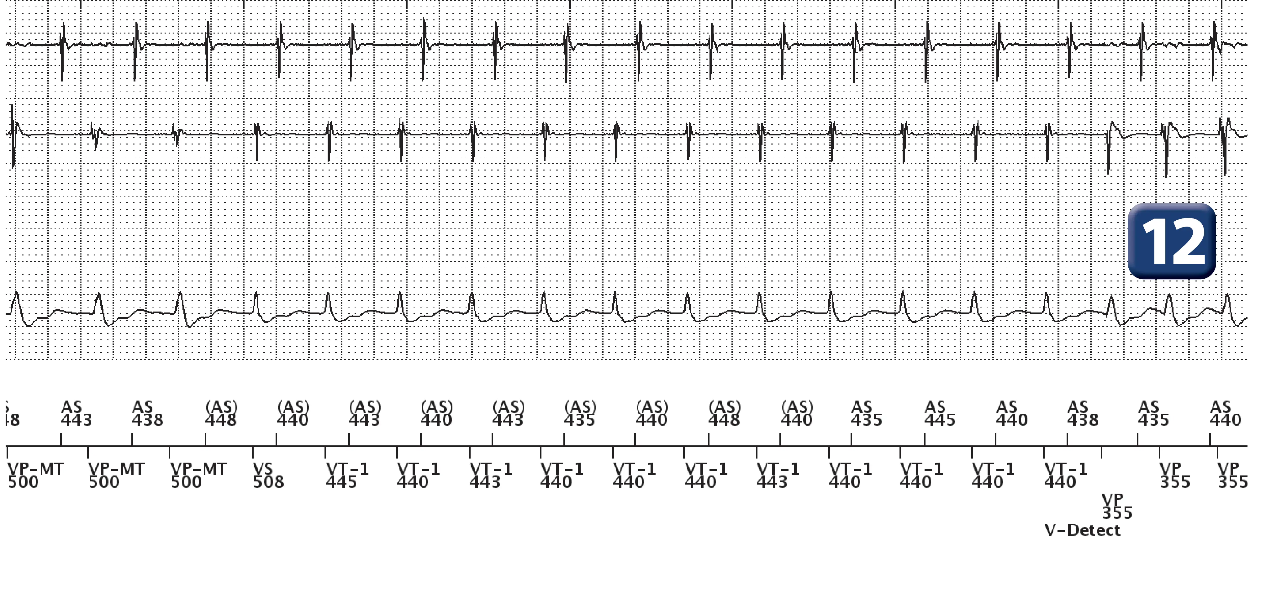 Boston Scientific ICD electrogram, segment 6 of 13 — Dual-chamber discrimination, atrial refractory periods and V>A criterion