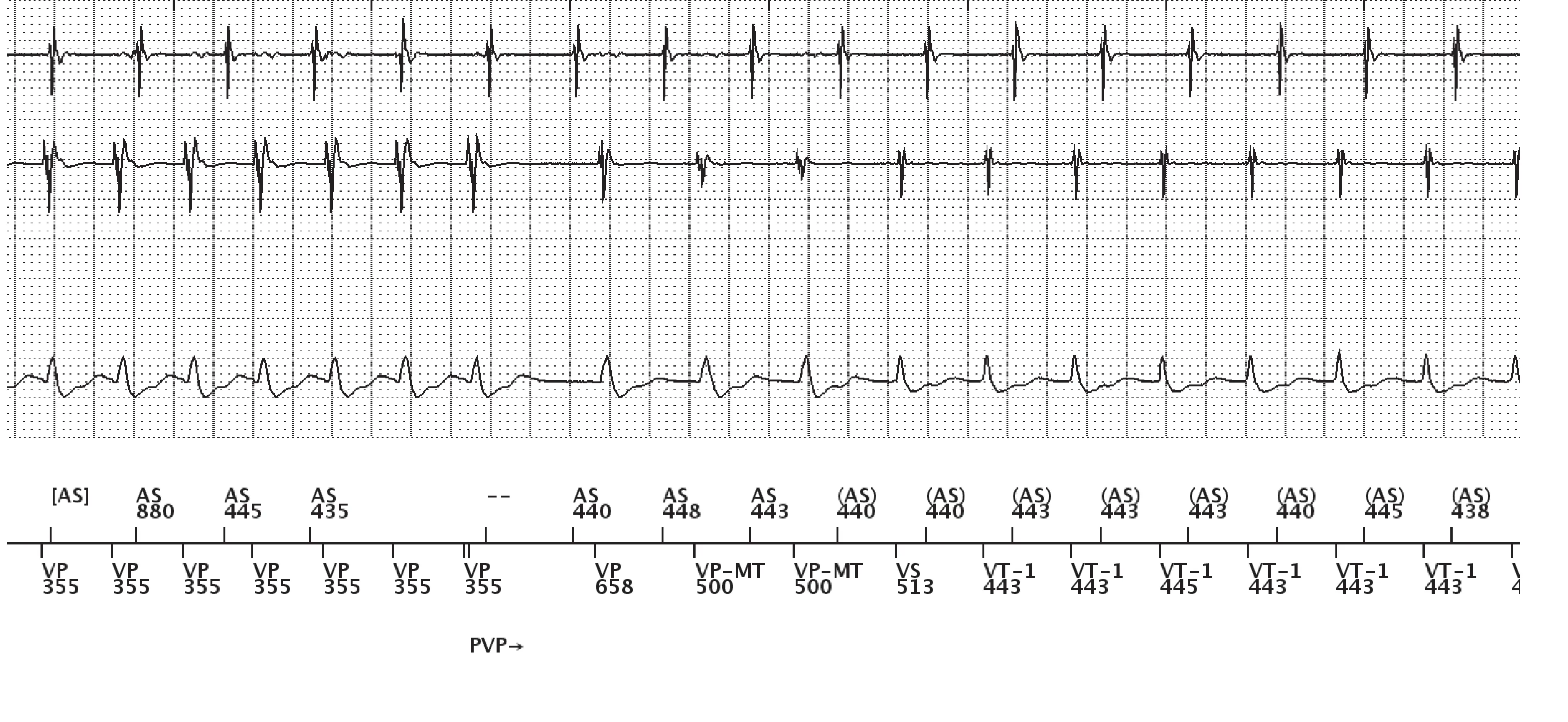 Boston Scientific ICD electrogram, segment 7 of 13 — Dual-chamber discrimination, atrial refractory periods and V>A criterion