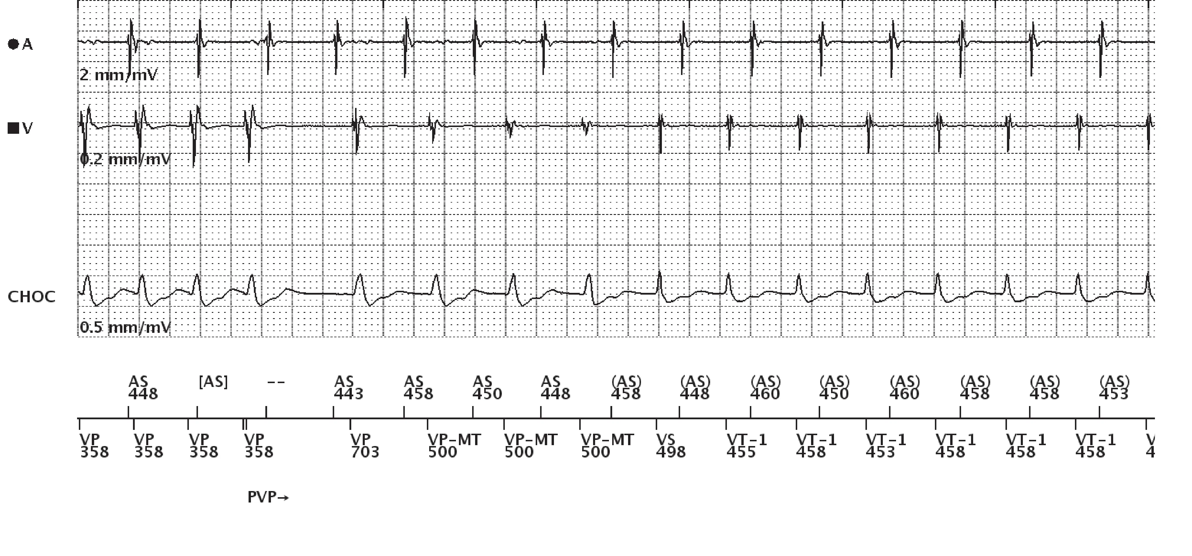 Boston Scientific ICD electrogram, segment 9 of 13 — Dual-chamber discrimination, atrial refractory periods and V>A criterion